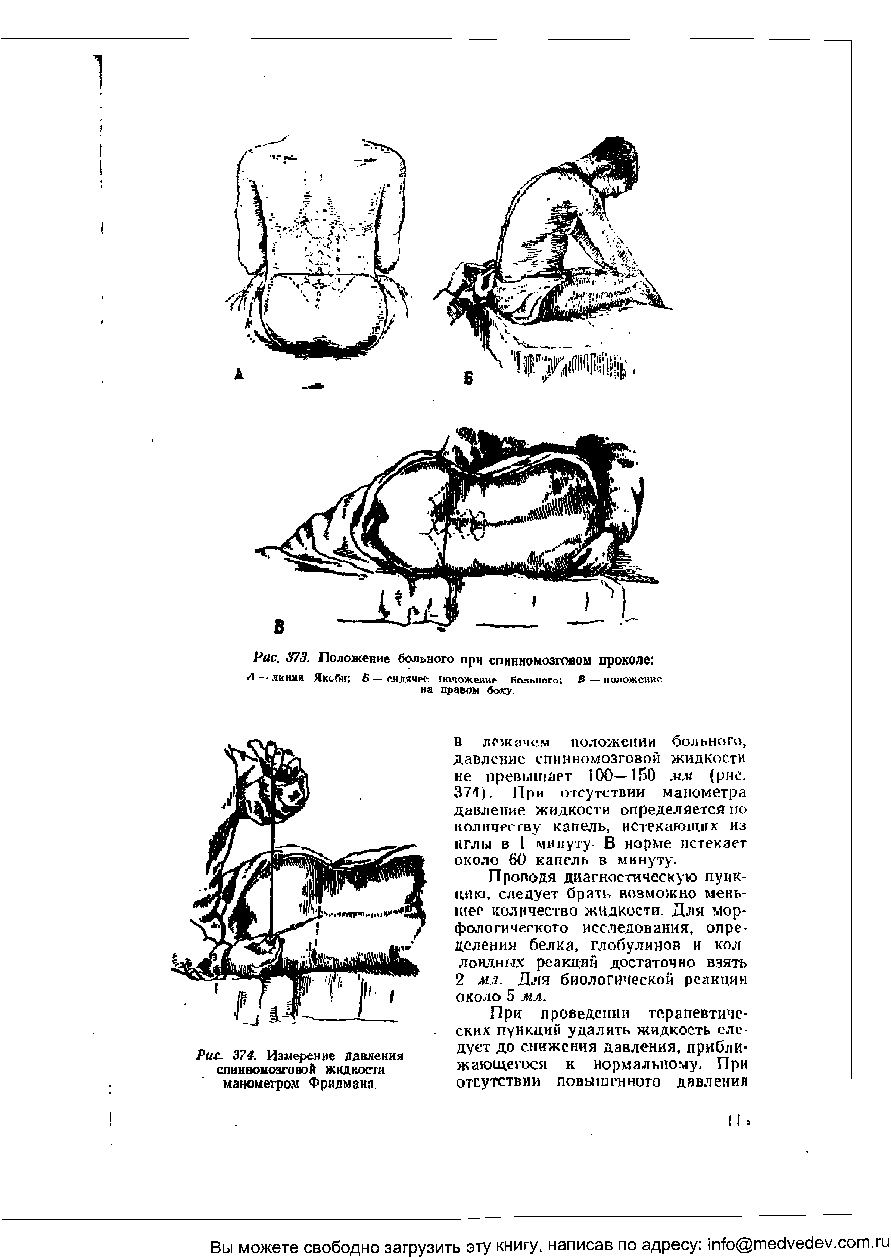 Рис. 374. Измерение давления спинномозговой жидкости манометром Фридмана.