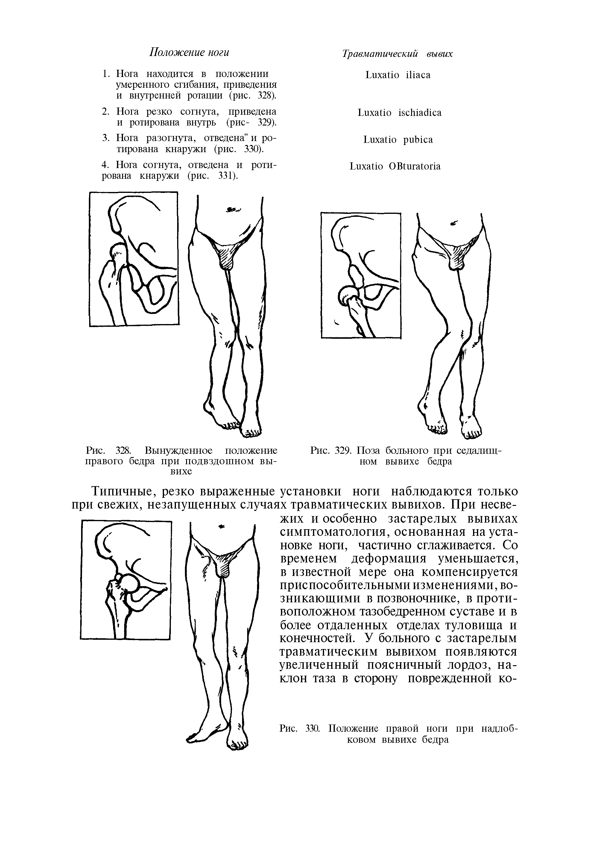 Рис. 330. Положение правой ноги при надлобковом вывихе бедра...
