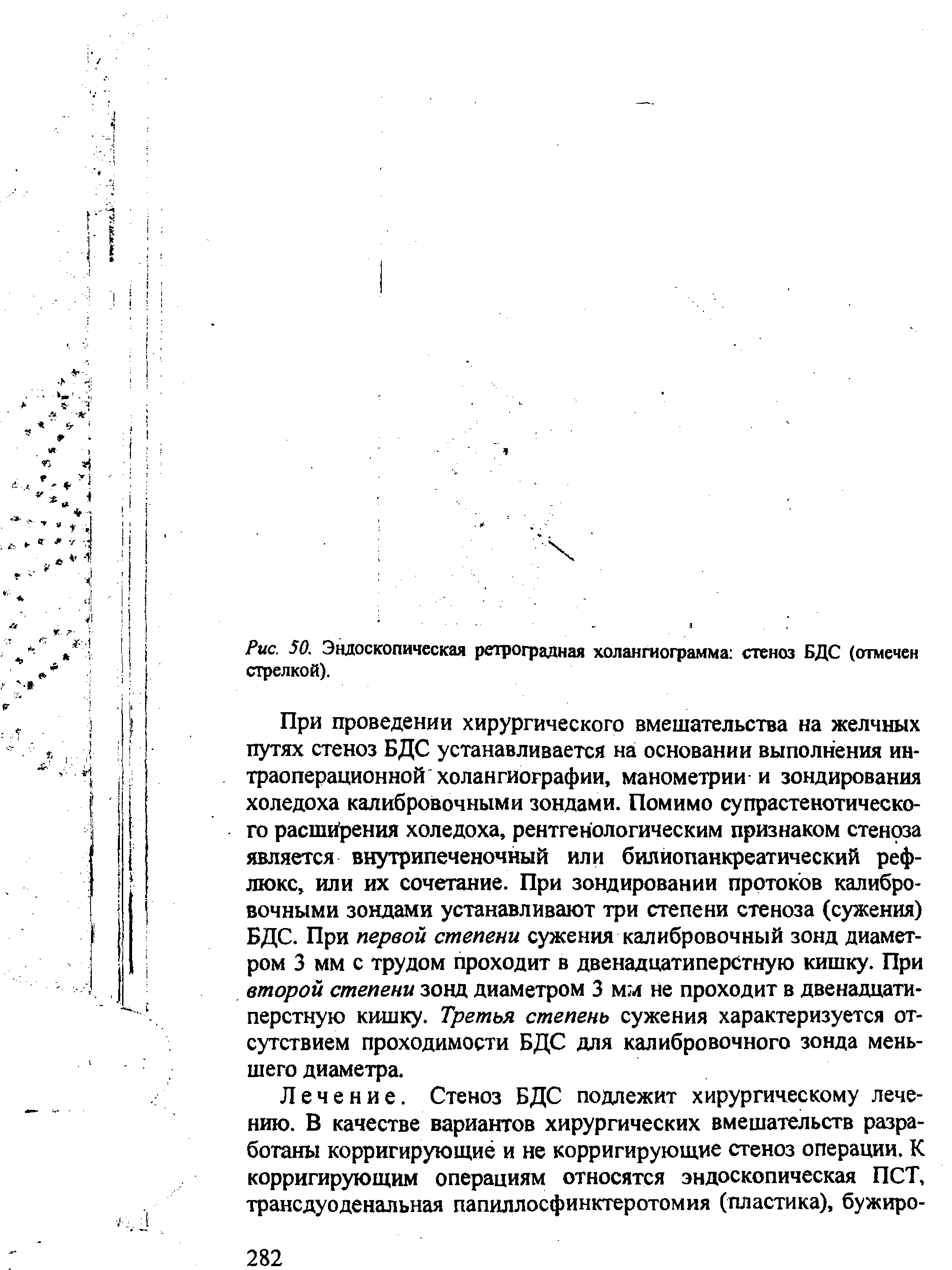 Рис. 50. Эндоскопическая ретроградная холангиограмма стеноз БДС (отмечен стрелкой).