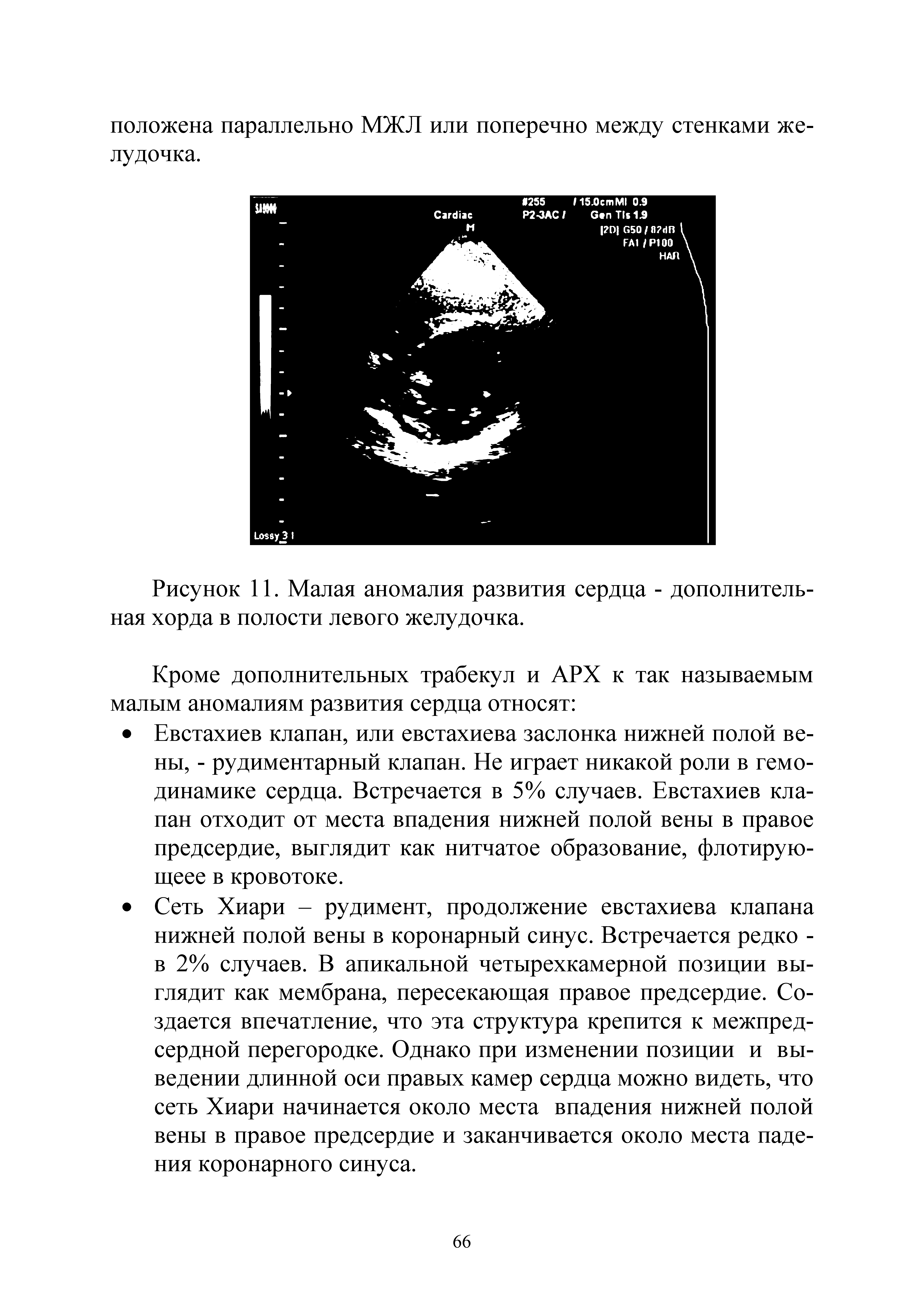 Рисунок 11. Малая аномалия развития сердца - дополнительная хорда в полости левого желудочка.