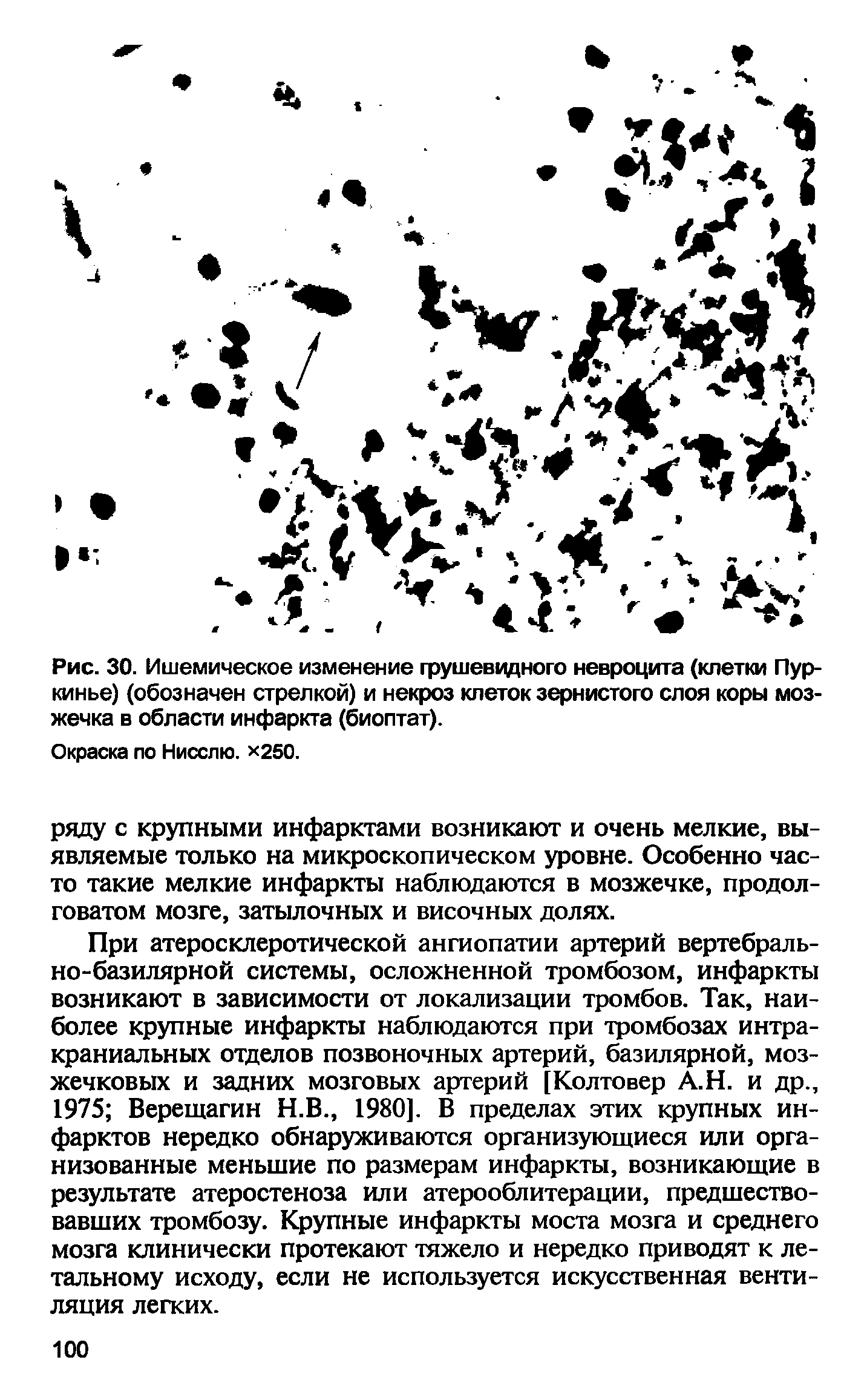 Рис. 30. Ишемическое изменение грушеводного невроцита (клетки Пуркинье) (обозначен стрелкой) и некроз клеток зернистого слоя коры мозжечка в области инфаркта (биоптат).