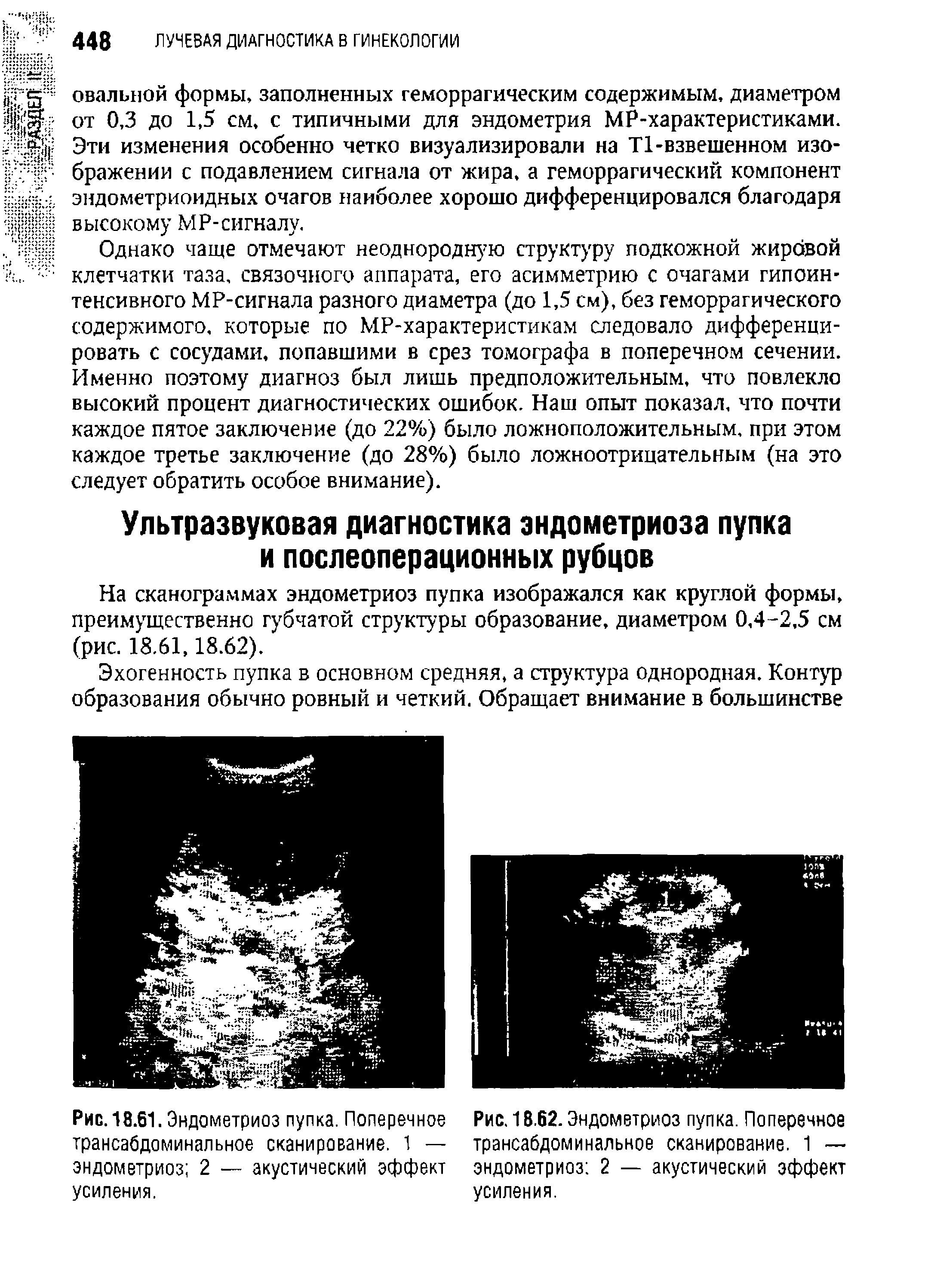 Рис. 18.61. Эндометриоз пупка. Поперечное трансабдоминальное сканирование. 1 — эндометриоз 2 — акустический эффект усиления.