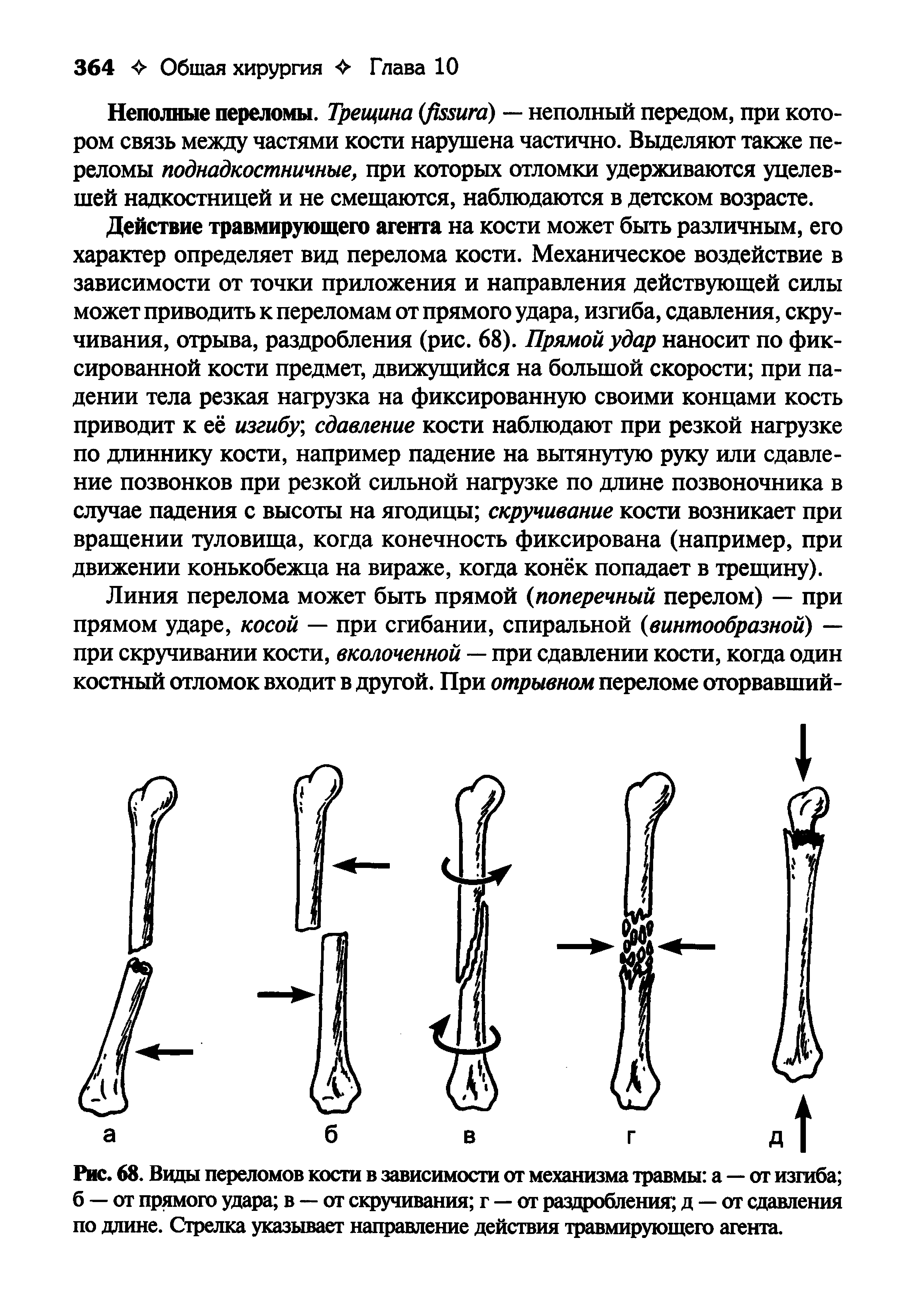 Рис. 68. Вицы переломов кости в зависимости от механизма травмы а — от изгиба б — от прямого удара в — от скручивания г — от раздробления д — от сдавления по длине. Стрелка указывает направление действия травмирующего агента.