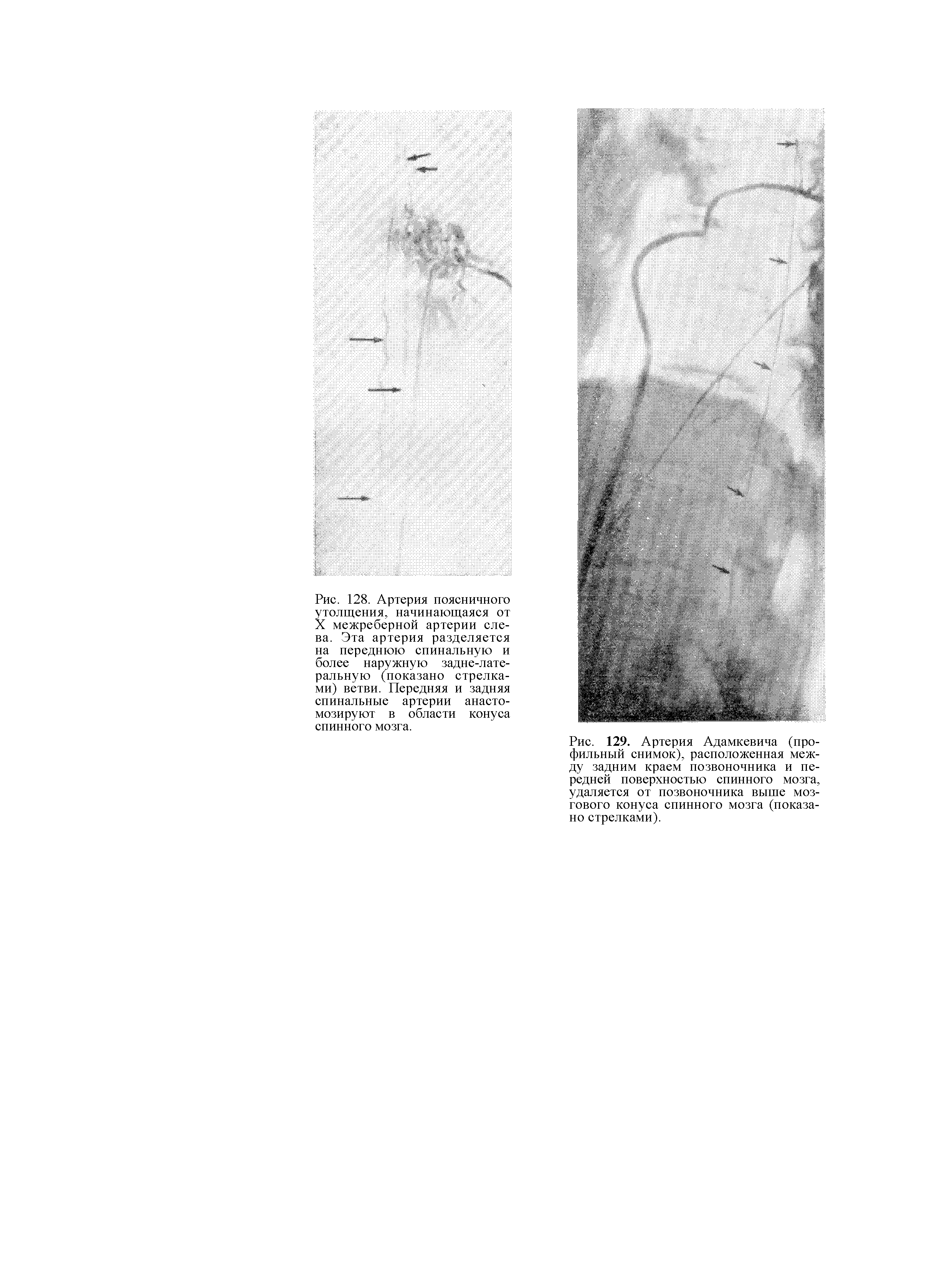 Рис. 129. Артерия Адамкевича (профильный снимок), расположенная между задним краем позвоночника и передней поверхностью спинного мозга, удаляется от позвоночника выше мозгового конуса спинного мозга (показано стрелками).