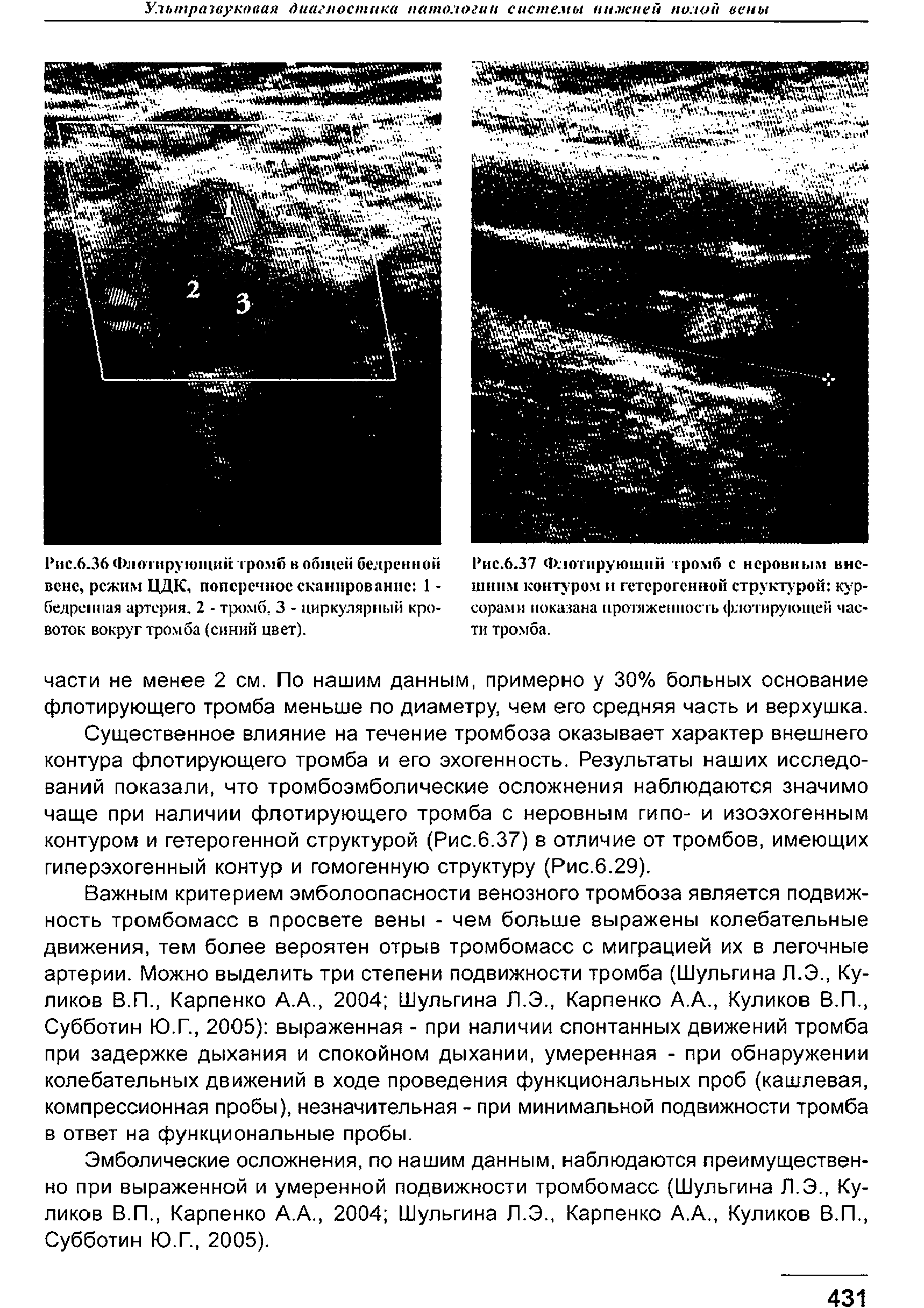 Рис.6.37 Флотирующий громб с неровным внешним контуром и гетерогенной структурой курсорами показана протяженность флотирующей части тромба.