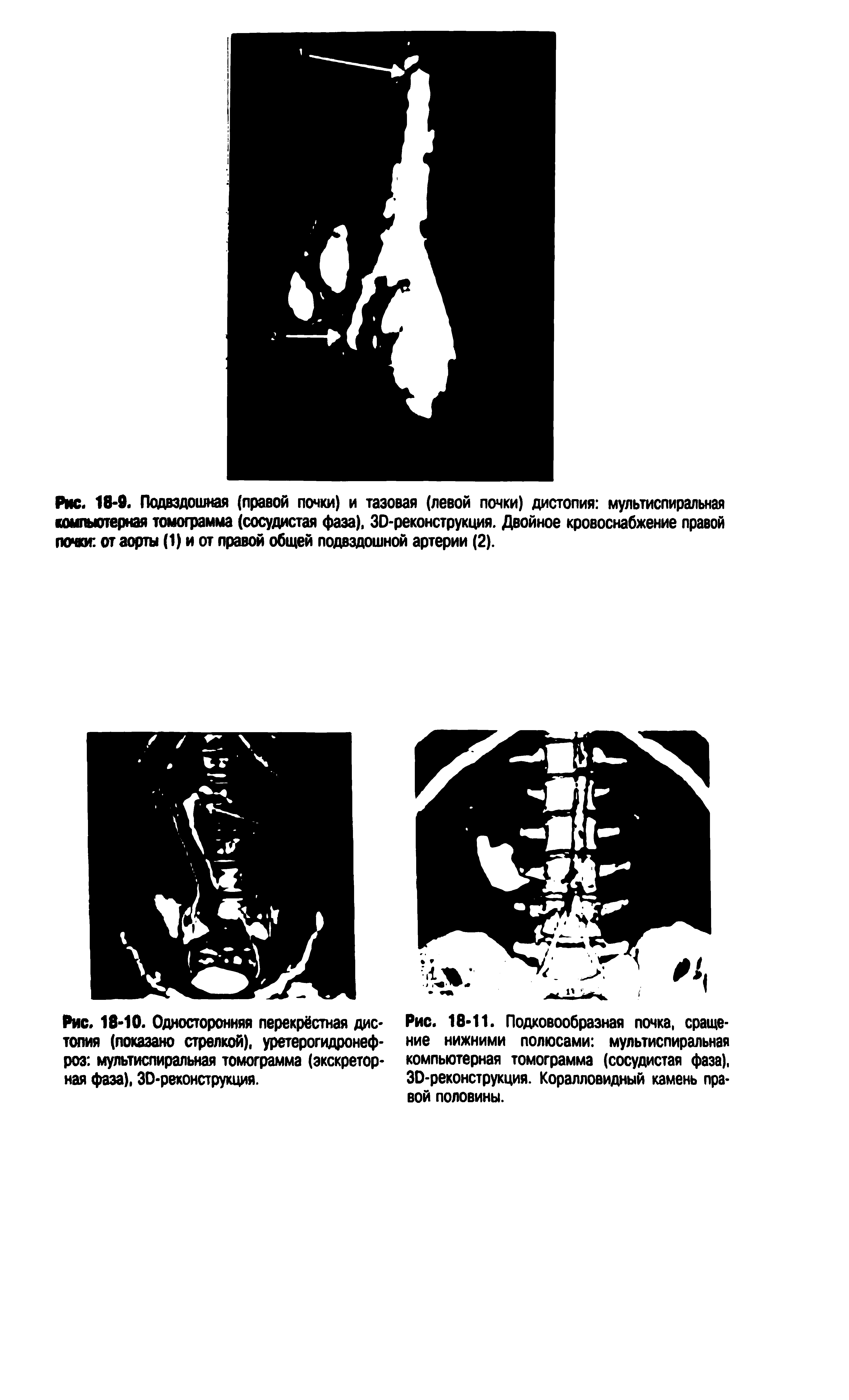 Рис. 18-10. Односторонняя перекрёстная дистопия (показано стрелкой), уретерогидронеф-роз мультиспиральная томограмма (экскреторная фаза). ЗО-реконструкция.