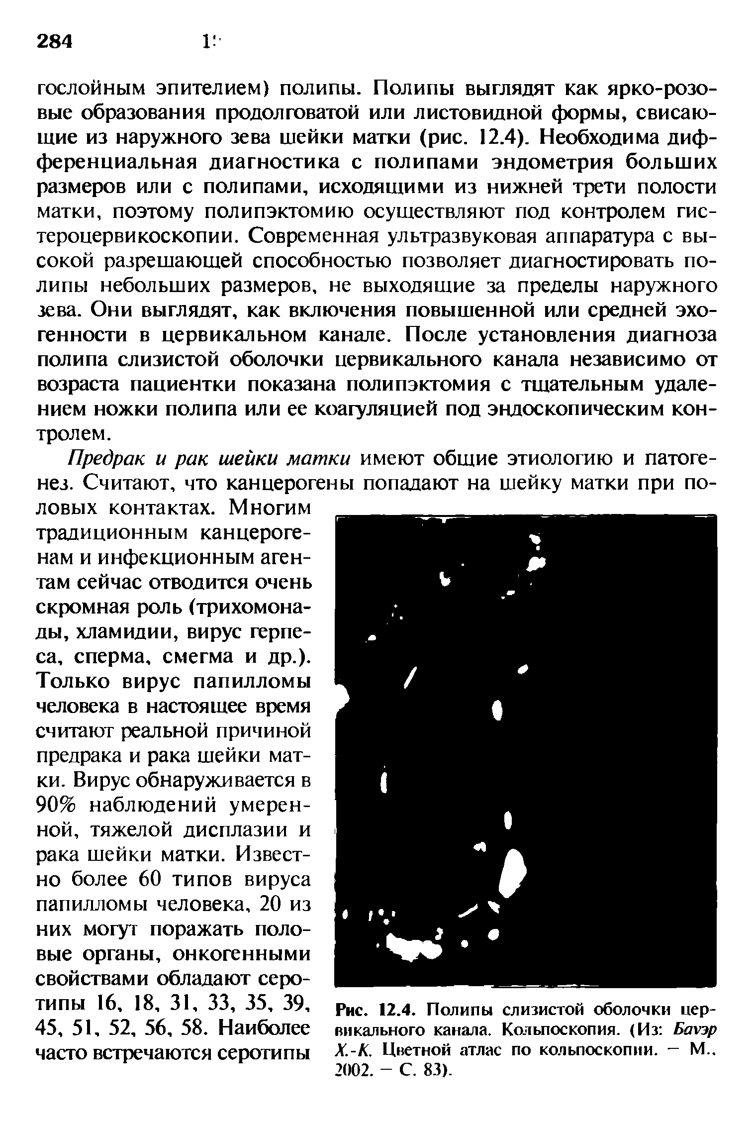 Рис. 12.4. Полипы слизистой оболочки цервикального канала. Кольпоскопия. (Из Бауэр Х.-К. Цветной атлас по кольпоскопии. — М.. 2002. - С. 83).