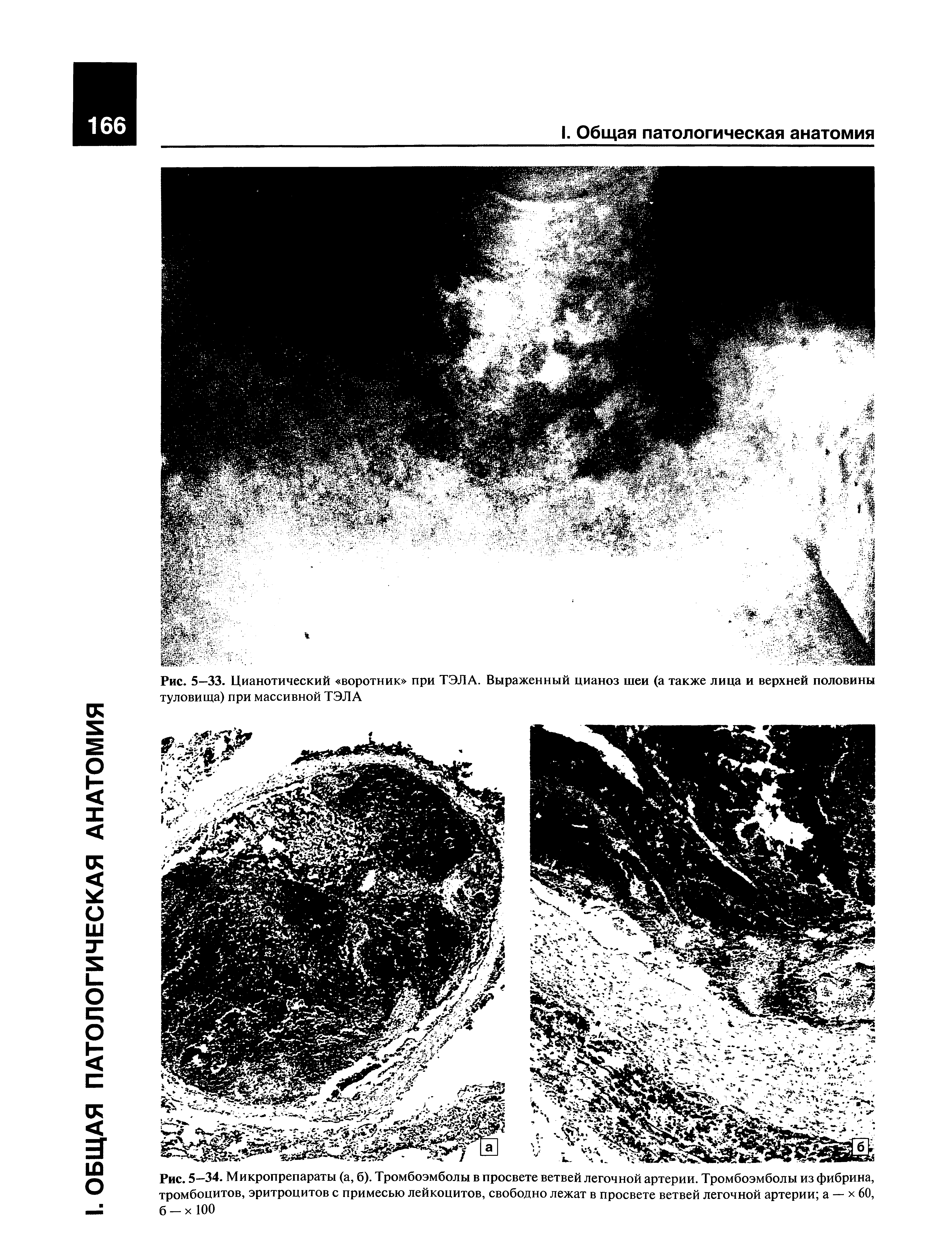 Рис. 5—34. Микропрепараты (а, б). Тромбоэмболы в просвете ветвей легочной артерии. Тромбоэмболы из фибрина, тромбоцитов, эритроцитов с примесью лейкоцитов, свободно лежат в просвете ветвей легочной артерии а — х 60, б — х 100...
