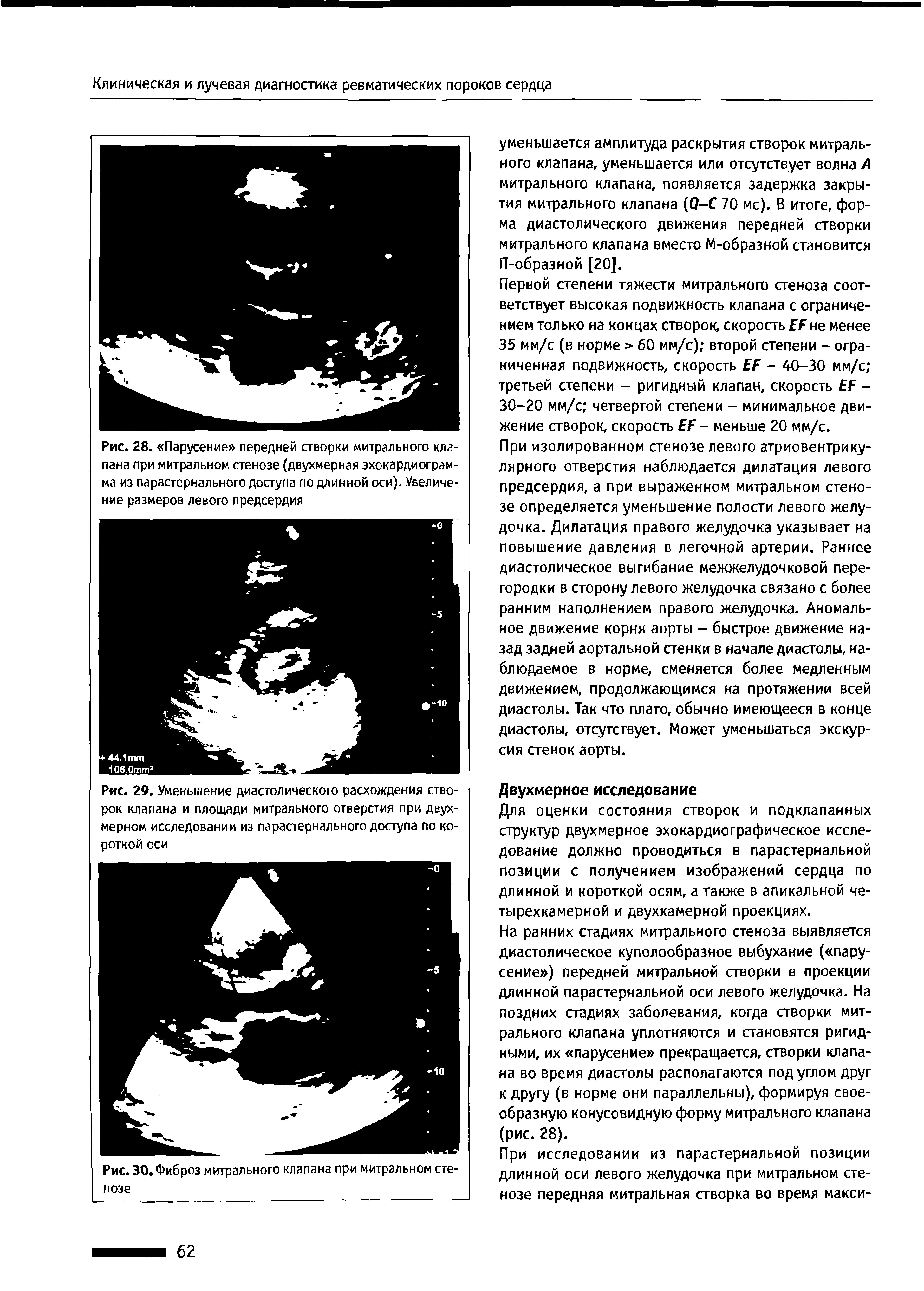 Рис. 29. Уменьшение диастолического расхождения створок клапана и площади митрального отверстия при двухмерном исследовании из парастернального доступа по короткой оси...