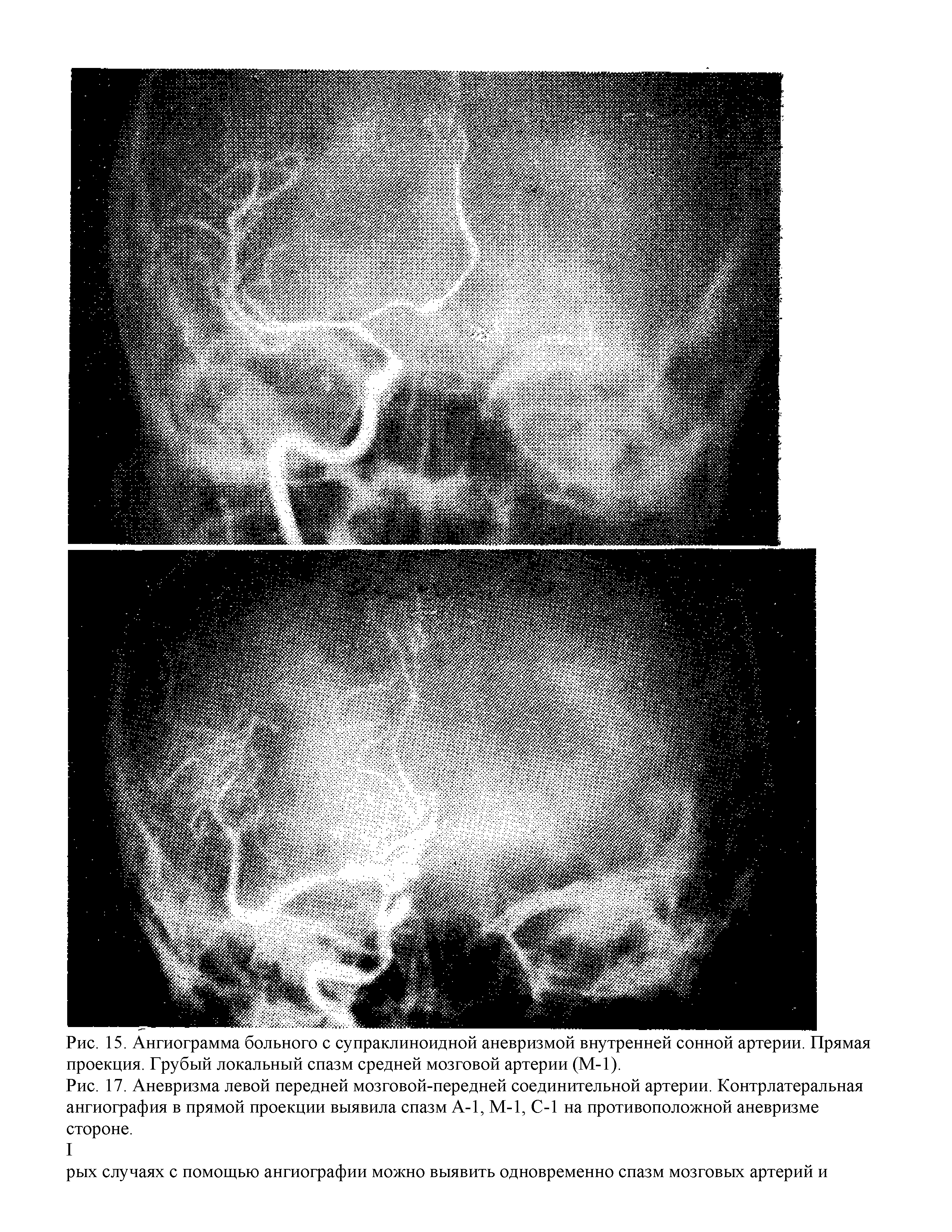 Рис. 17. Аневризма левой передней мозговой-передней соединительной артерии. Контрлатеральная ангиография в прямой проекции выявила спазм А-1, М-1, С-1 на противоположной аневризме...