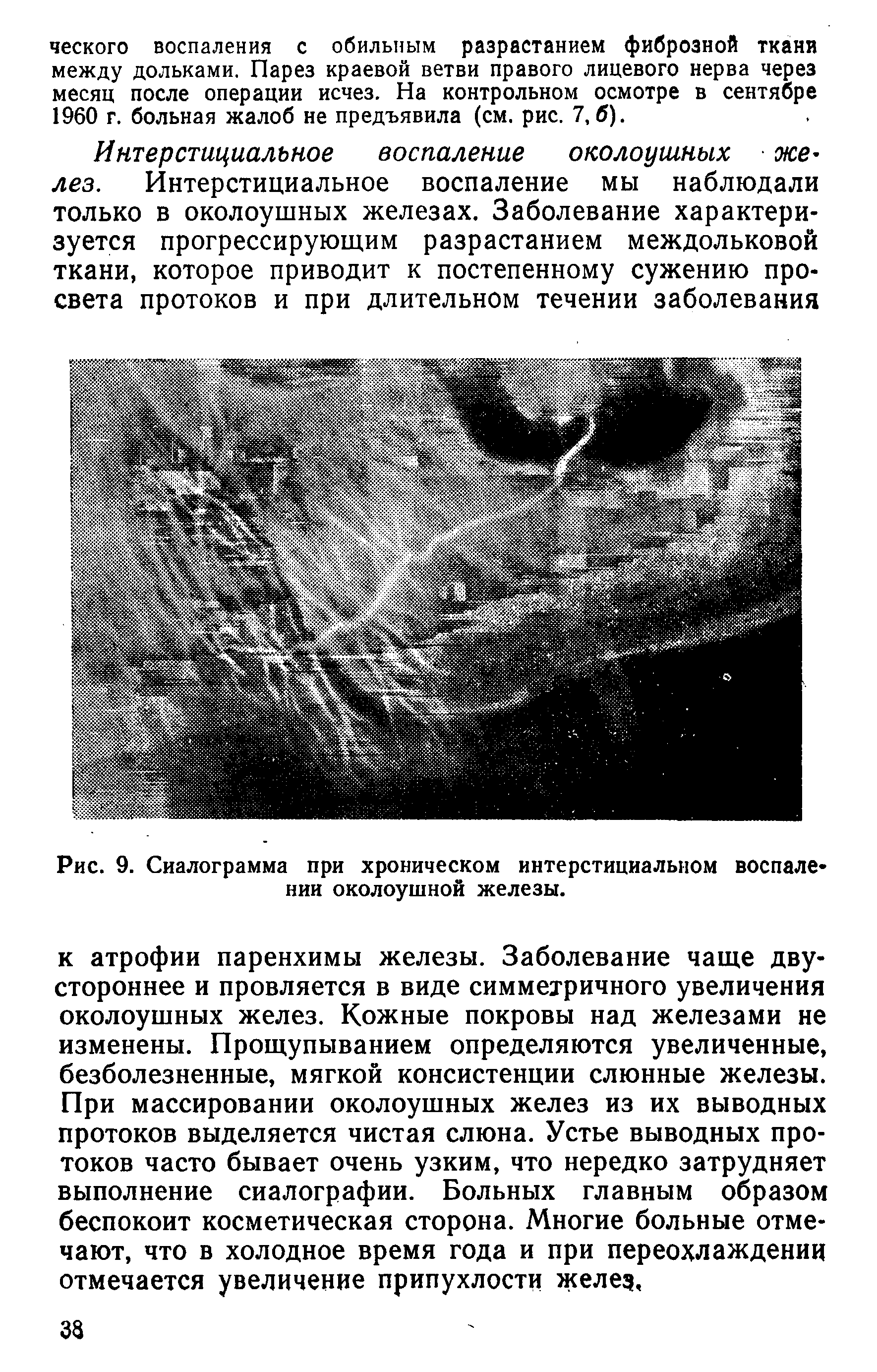 Рис. 9. Сиалограмма при хроническом интерстициальном воспалении околоушной железы.