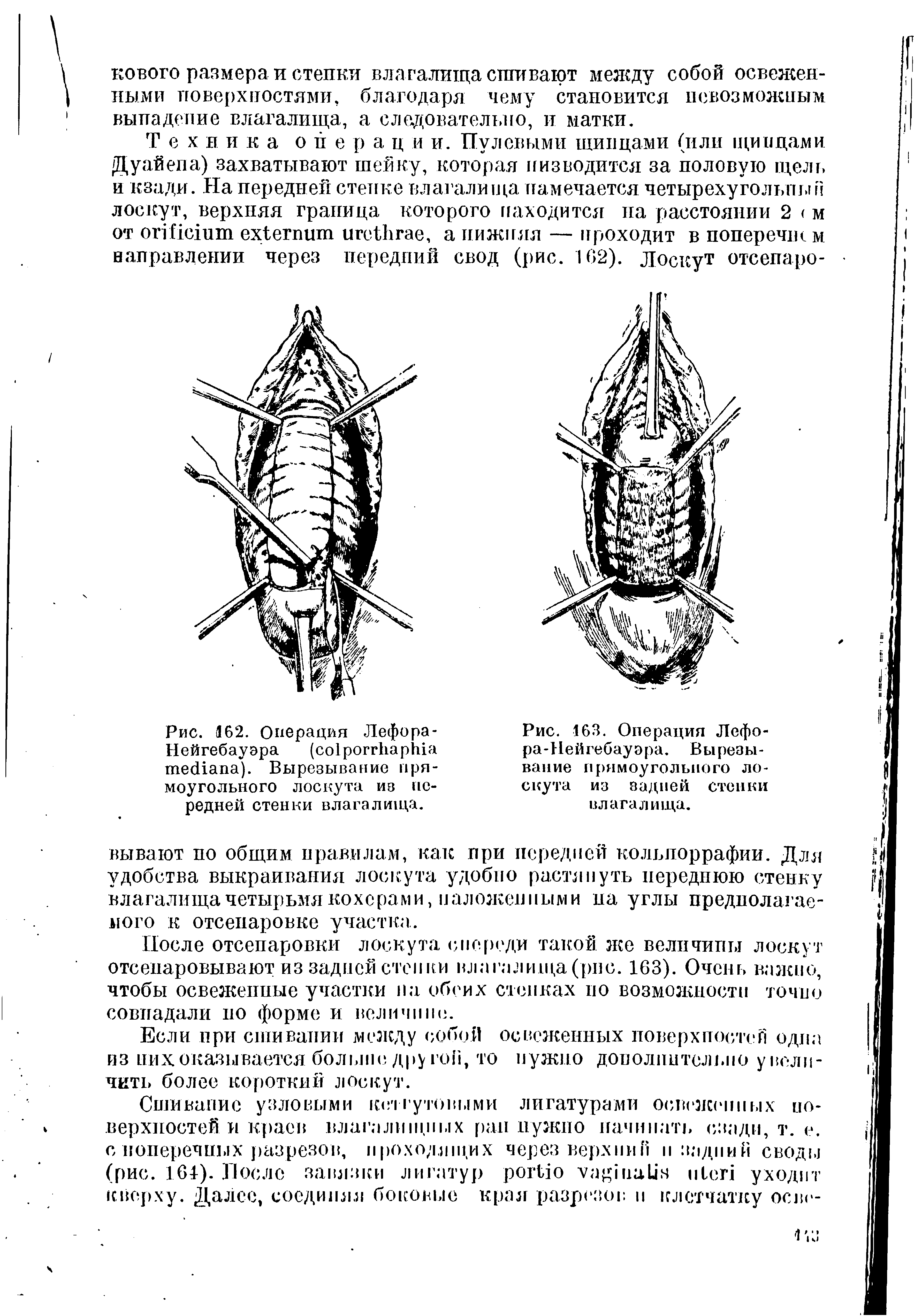 Рис. 162. Операция Лефора-Нейгебауэра ( ). Вырезывание прямоугольного лоскута из передней стенки влагалища.