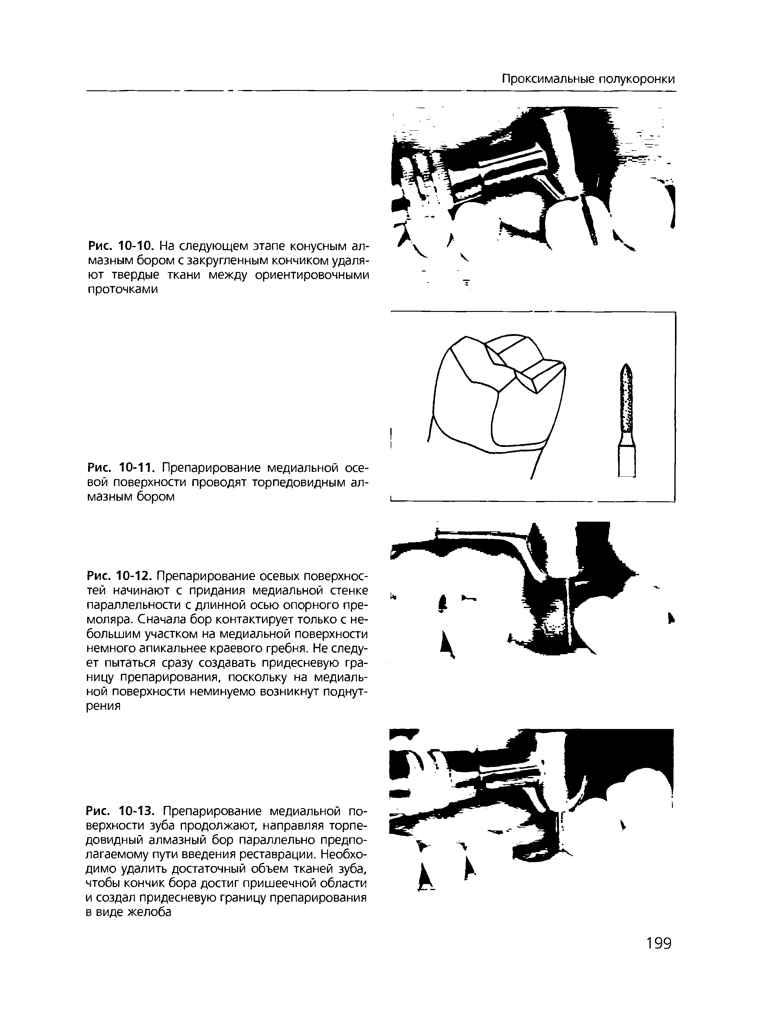 Рис. 10-13. Препарирование медиальной поверхности зуба продолжают, направляя торпедовидный алмазный бор параллельно предполагаемому пути введения реставрации. Необходимо удалить достаточный объем тканей зуба, чтобы кончик бора достиг пришеечной области и создал придесневую границу препарирования в виде желоба...