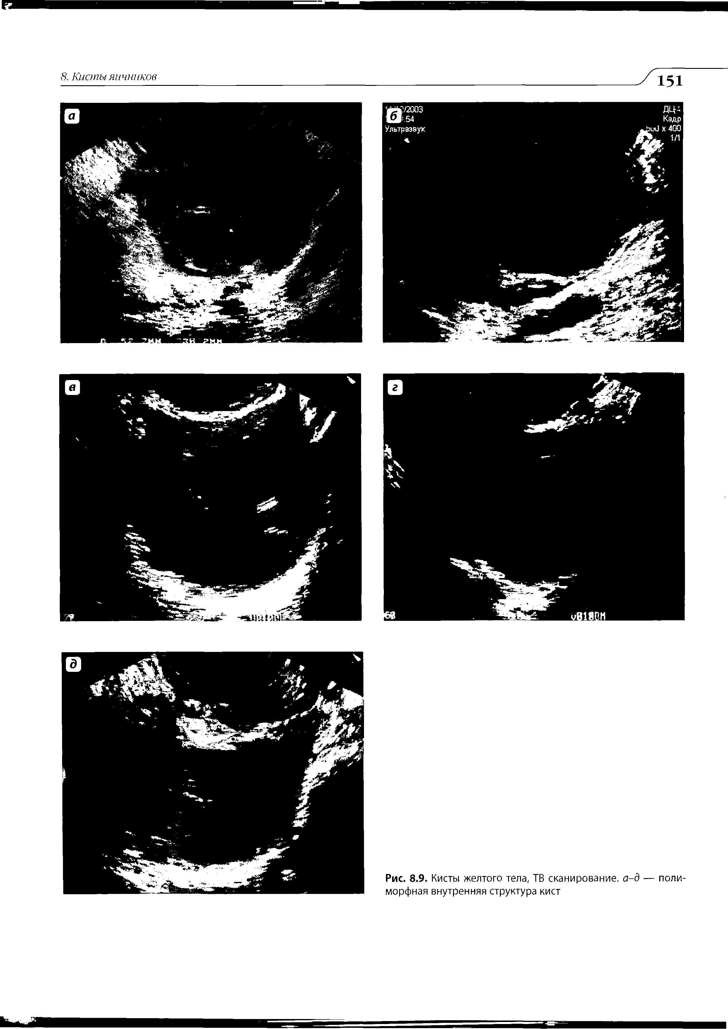 Рис. 8.9. Кисты желтого тела, ТВ сканирование, а-д — полиморфная внутренняя структура кист...