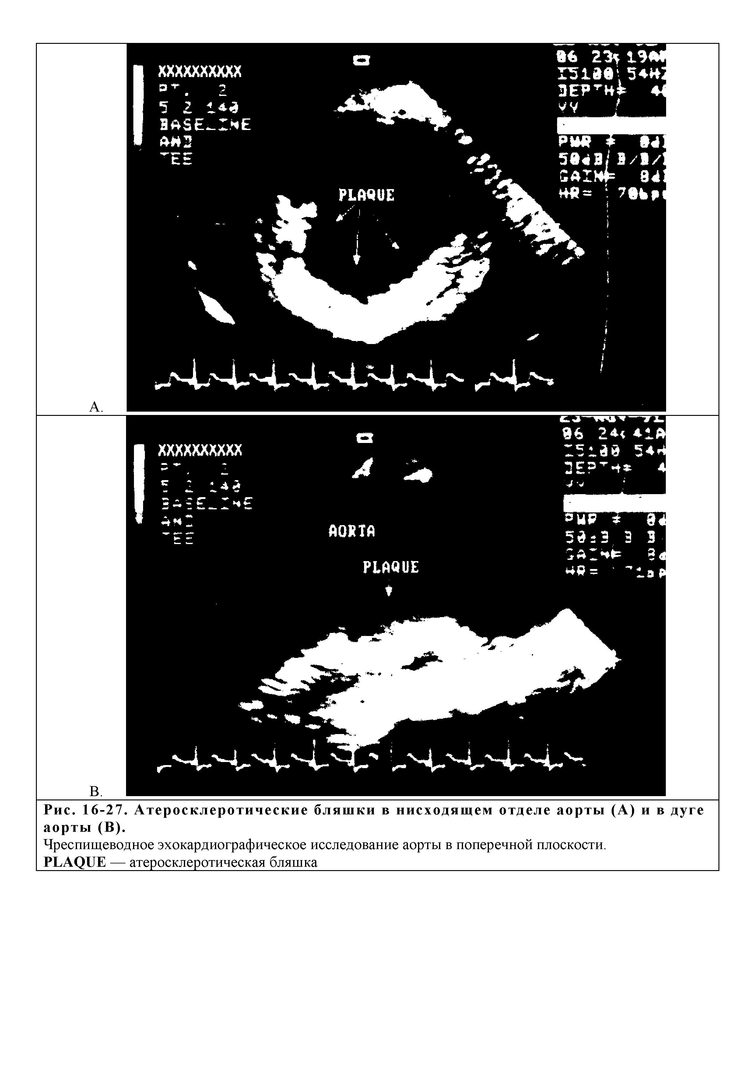 Рис. 16-27. Атеросклеротические бляшки в нисходящем отделе аорты (А) и в дуге аорты (В).