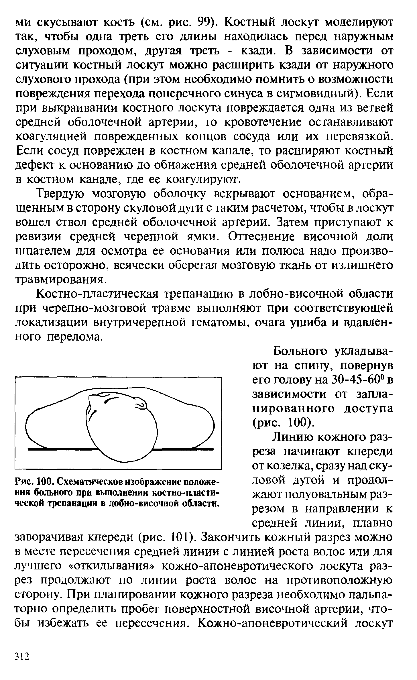 Рис. 100. Схематическое изображение положения больного при выполнении костно-пластической трепанации в лобно-височной области.