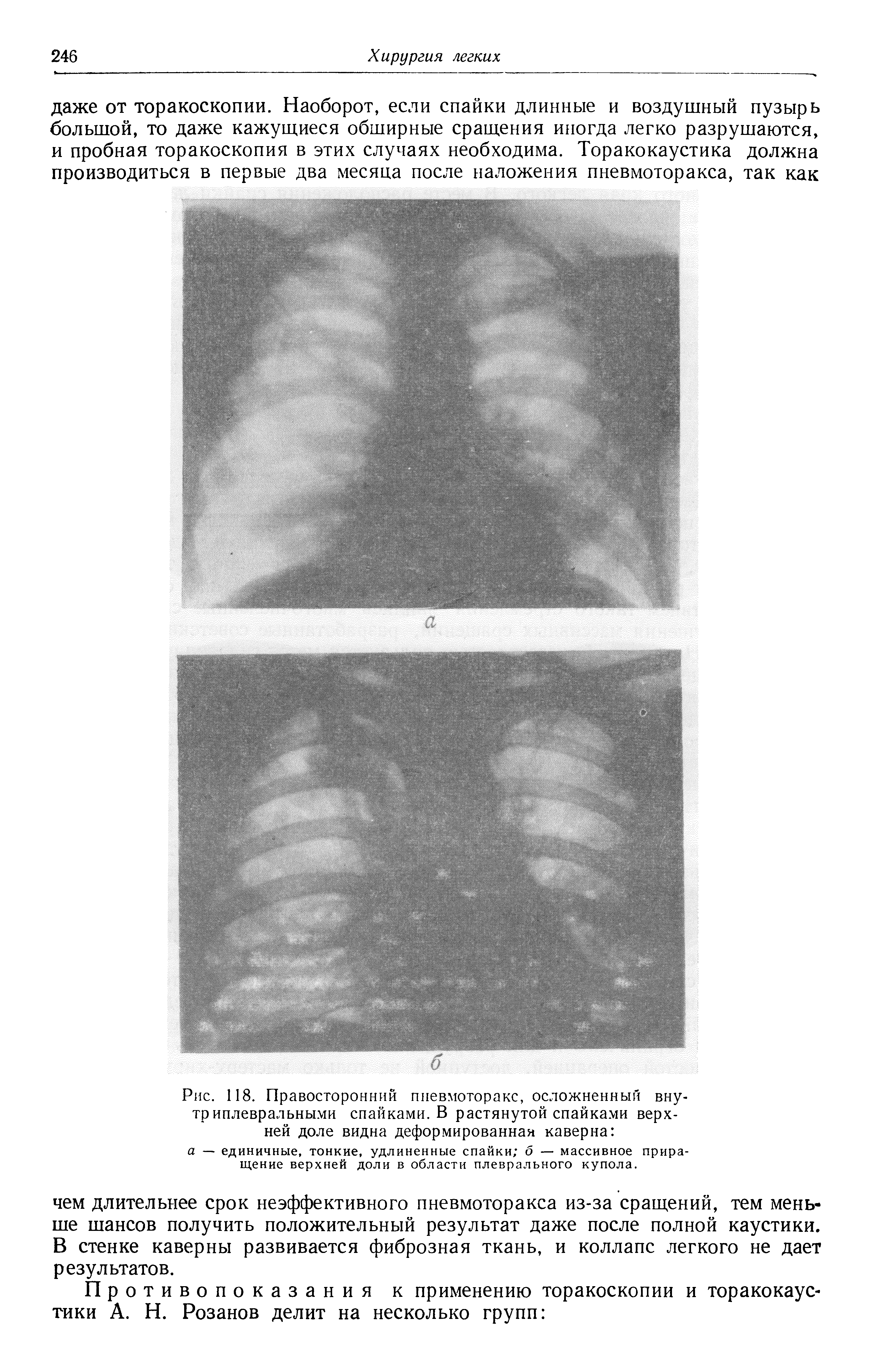 Рис. 118. Правосторонний пневмоторакс, осложненный внутриплевральными спайками. В растянутой спайками верхней доле видна деформированная каверна а — единичные, тонкие, удлиненные спайки б — массивное приращение верхней доли в области плеврального купола.