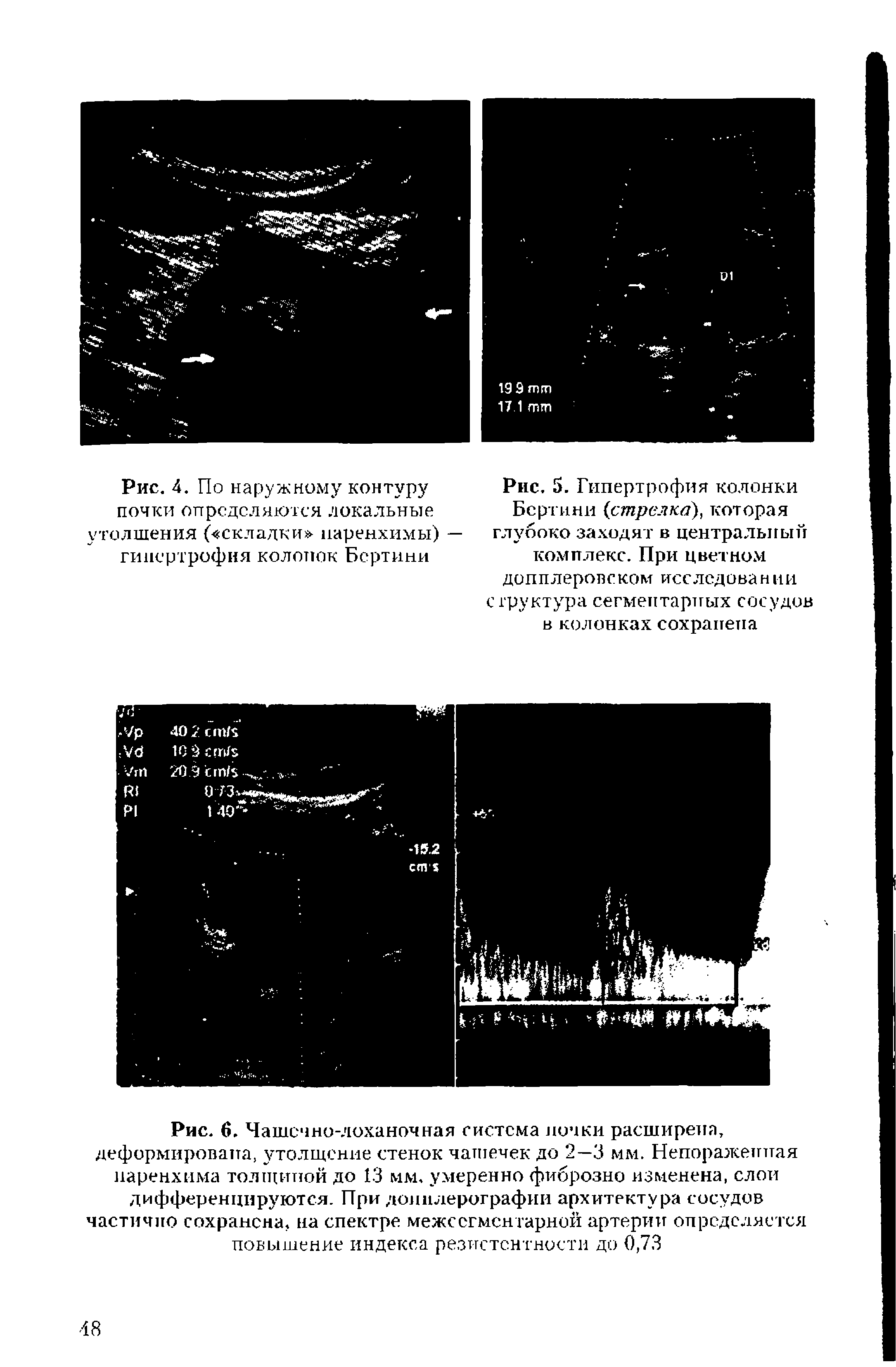 Рис. 5. Гипертрофия колонки Бертини (стрелка), которая глубоко заходят в центральный комплекс. При цветном допплеровском исследованпи структура сегментарных сосудов в колонках сохранена...