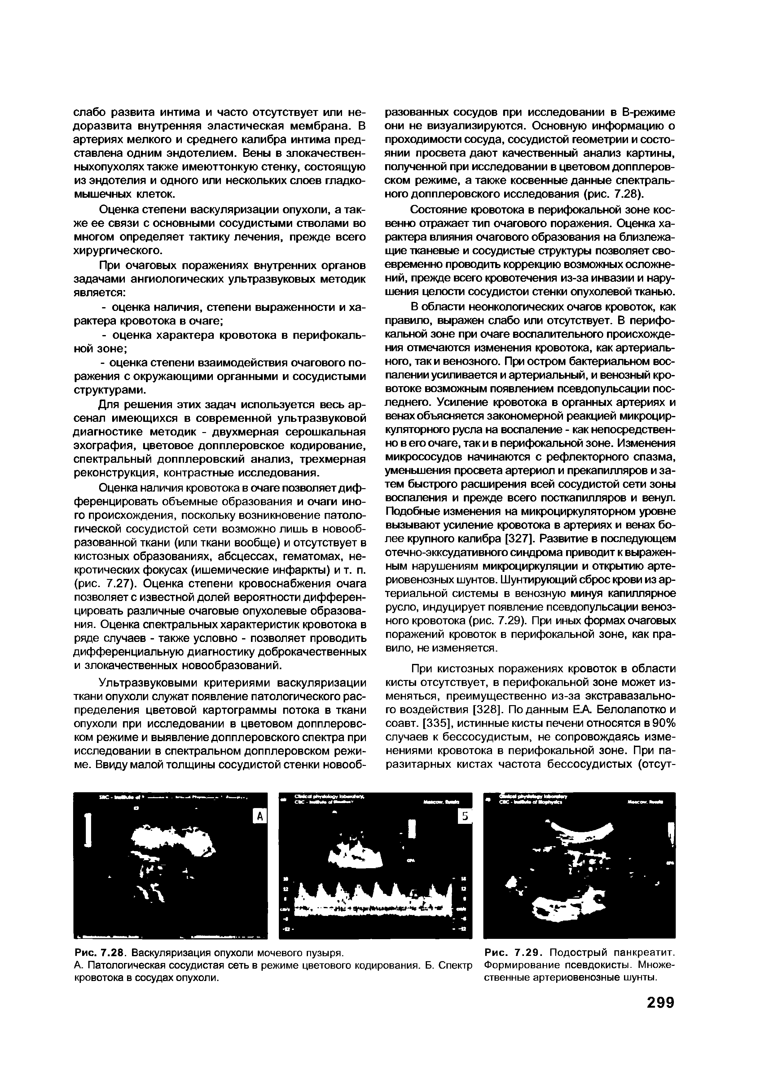 Рис. 7.29. Подострый панкреатит. Формирование псевдокисты. Множественные артериовенозные шунты.