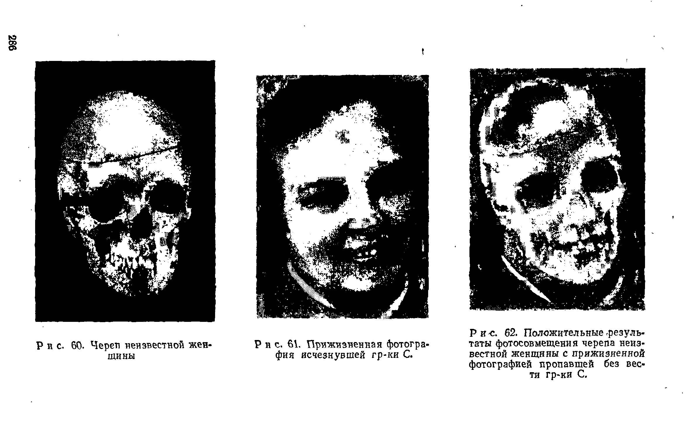 Рис. 62. Положительные-результаты фотосовмещения черепа неизвестной женщины с прижизненной фотографией пропавшей без вести гр-ки С.