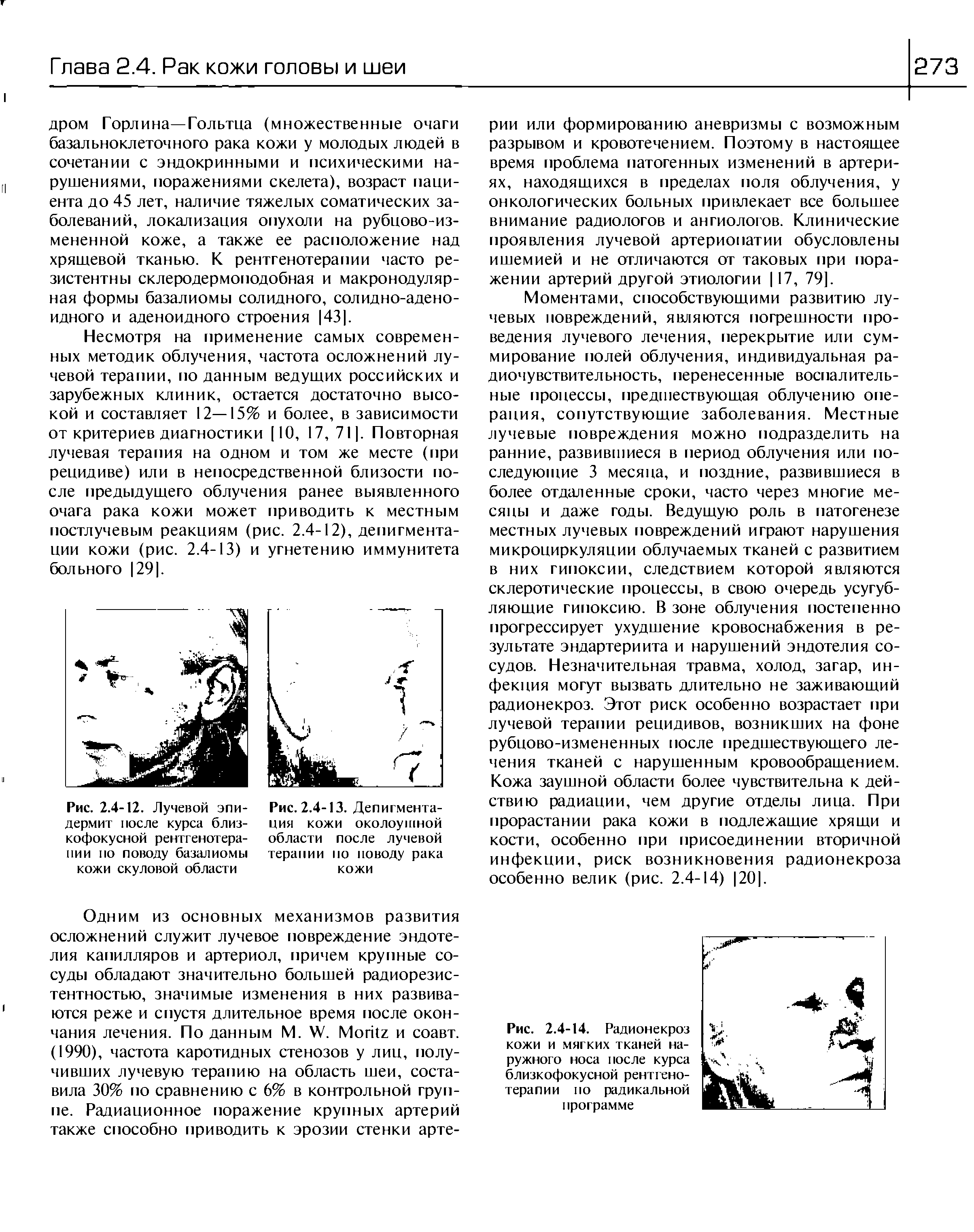 Рис. 2.4-13. Депигментация кожи околоушной области после лучевой терапии по поводу рака кожи...