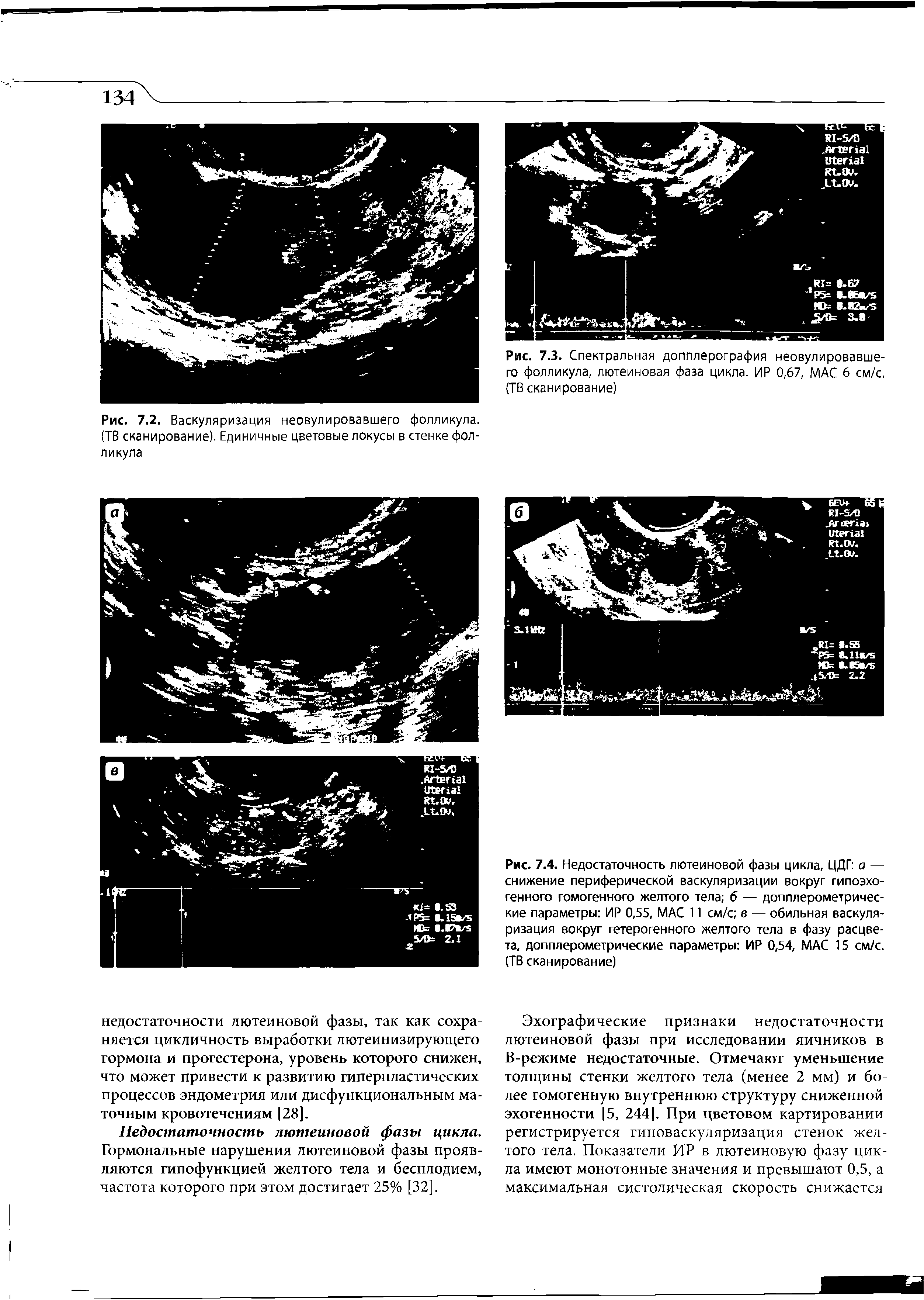 Рис. 7.3. Спектральная допплерография неовулировавшего фолликула, лютеиновая фаза цикла. ИР 0,67, МАС 6 см/с. (ТВ сканирование)...