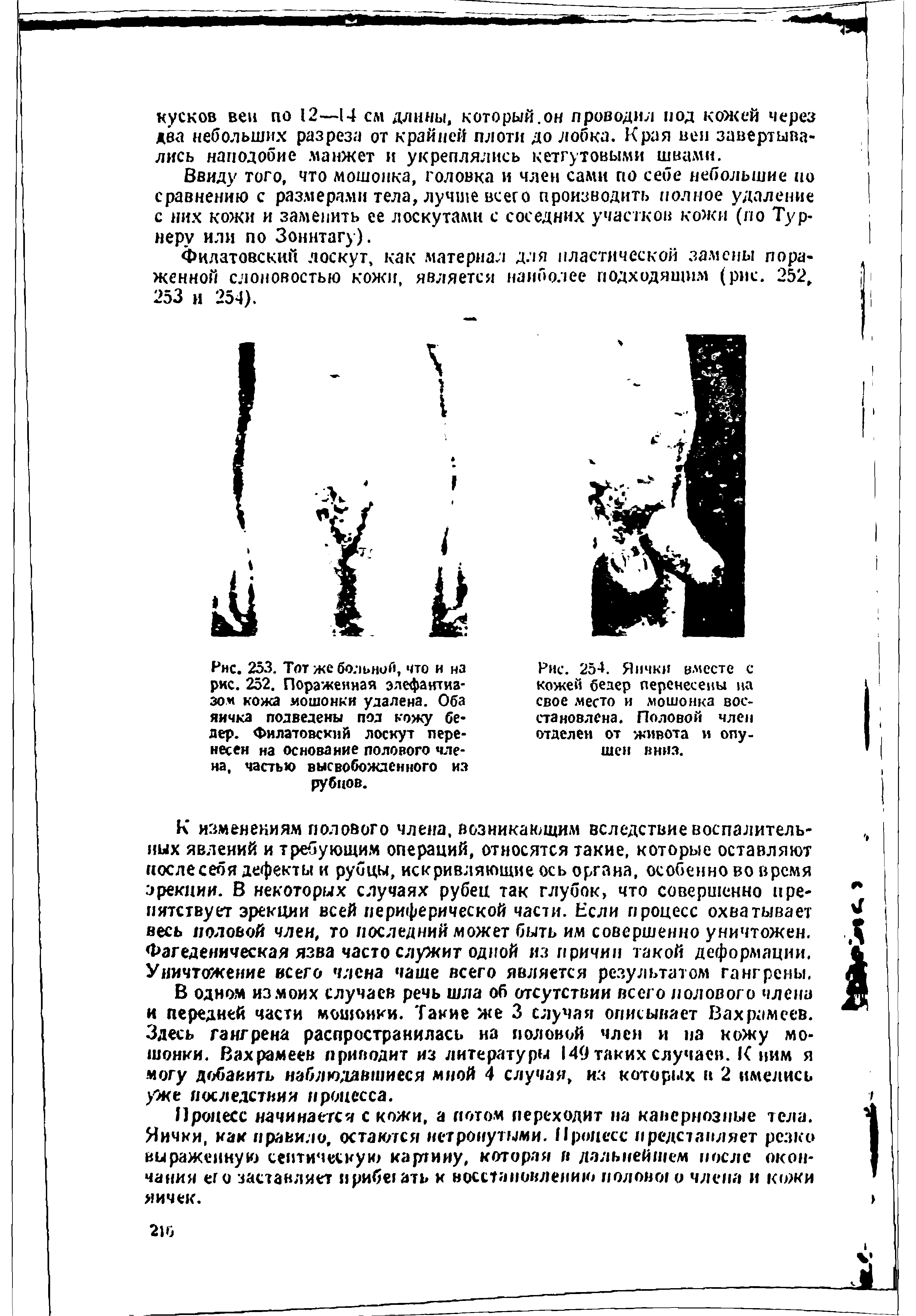 Рис. 254. Яички вместе с кожей бедер перенесены на свое место и мошонка восстановлена. Половой член отделен от живота и опушен вниз.