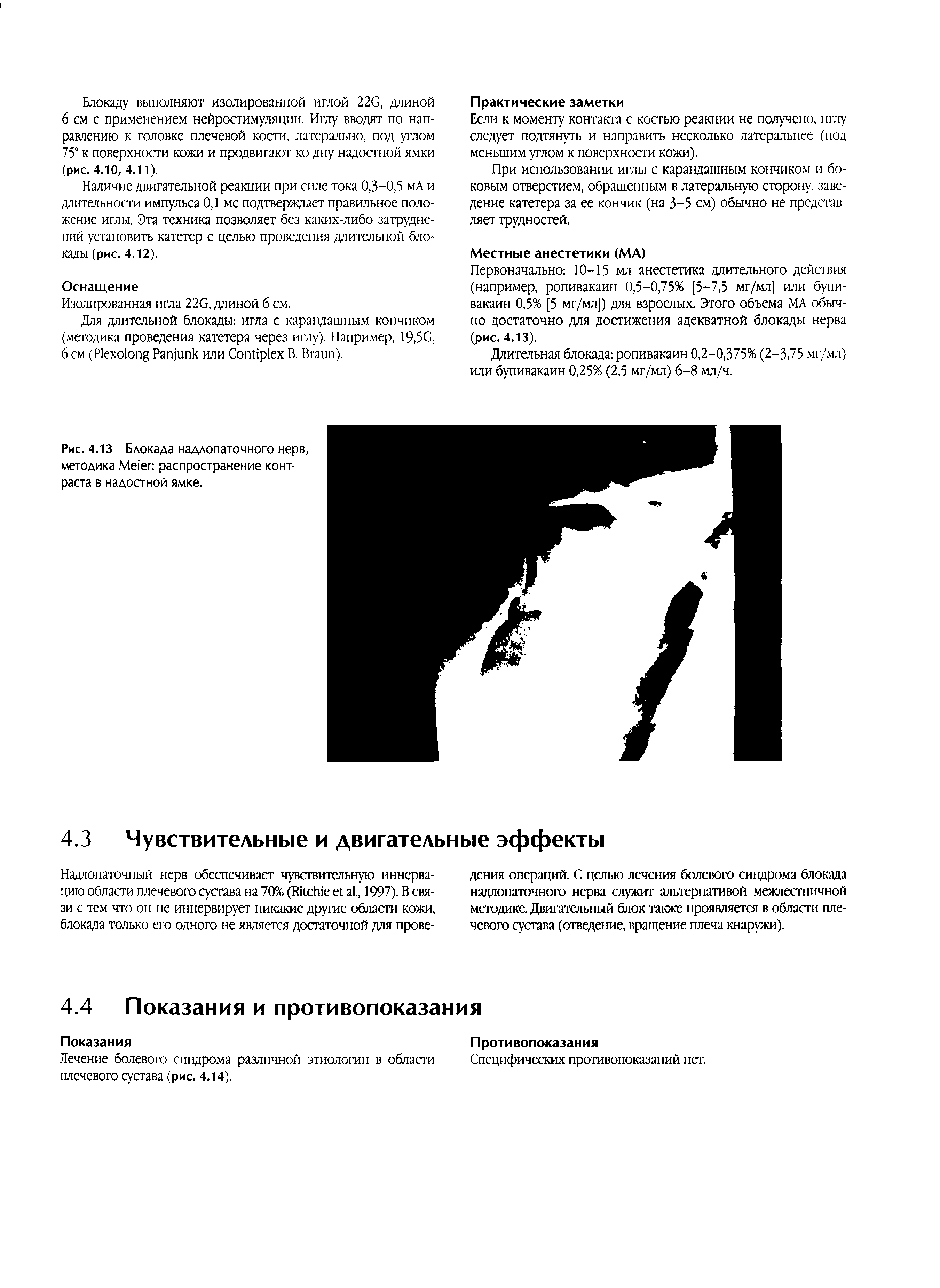 Рис. 4.13 Блокада надлопаточного нерв, методика M распространение контраста в надостной ямке.