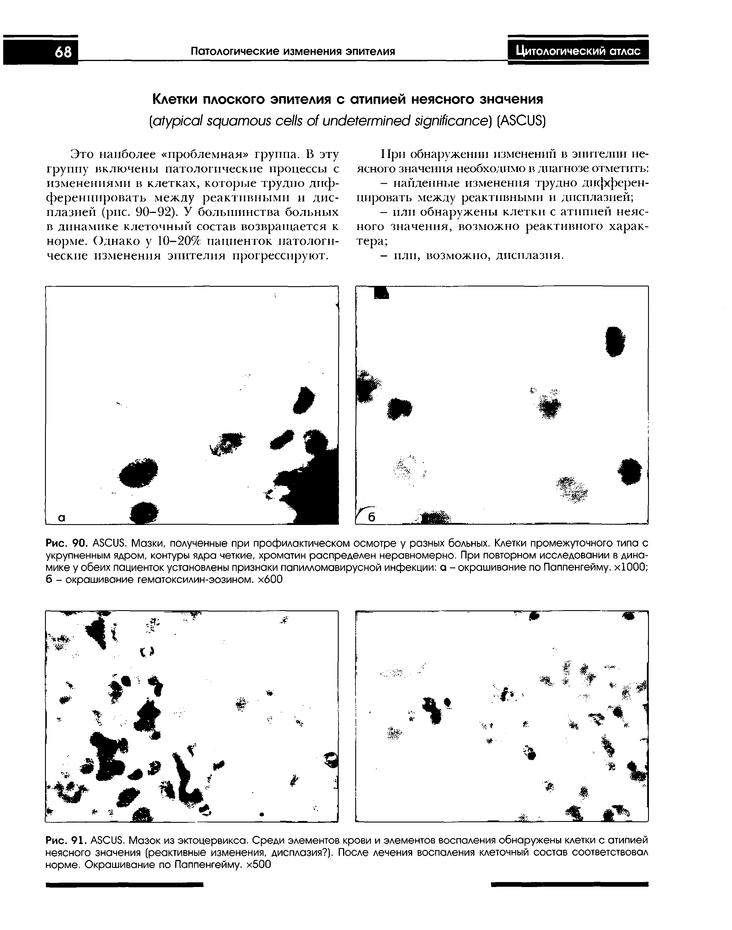 Рис. 91. ASCUS. Мазок из эктоцервикса. Среди элементов крови и элементов воспаления обнаружены клетки с атипией неясного значения (реактивные изменения, дисплазия ). После лечения воспаления клеточный состав соответствовал норме. Окрашивание по Паппенгейму. х500...