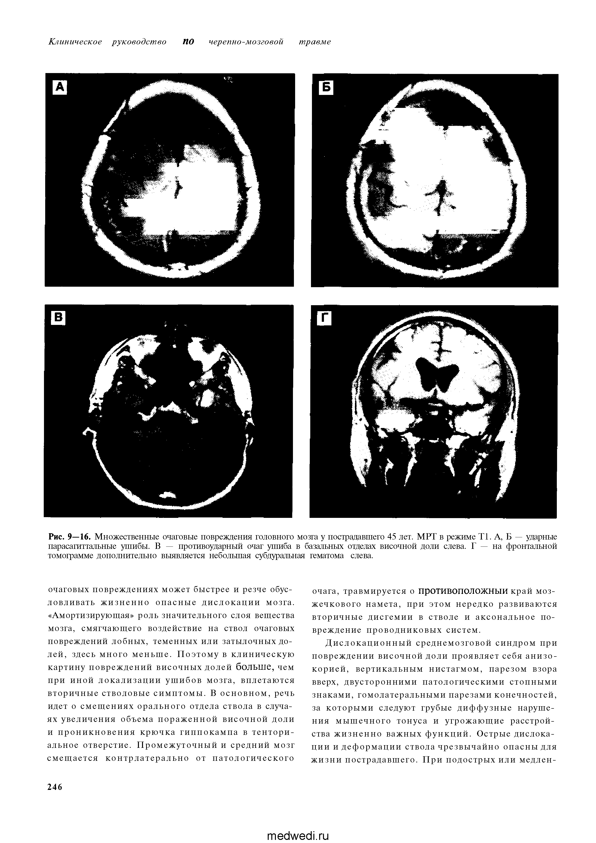 Рис. 9—16. Множественные очаговые повреждения головного мозга у пострадавшего 45 лет. МРТ в режиме Т1. А, Б — ударные парасагиттальные ушибы. В — противоударный очаг ушиба в базальных отделах височной доли слева. Г — на фронтальной томограмме дополнительно выявляется небольшая субдуральная гематома слева.