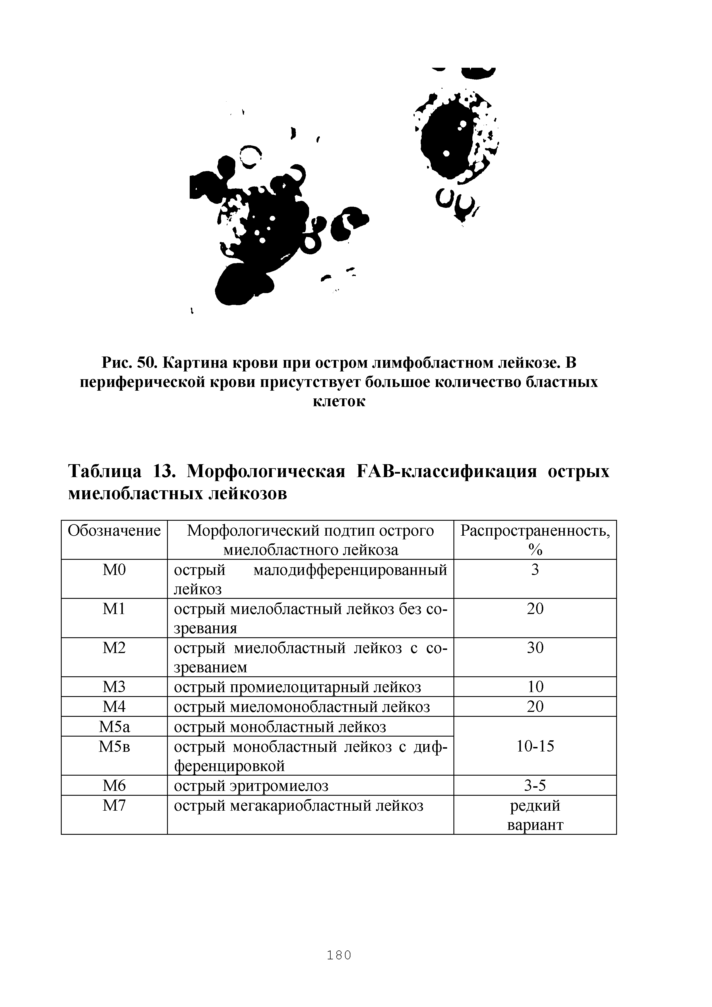 Таблица 13. Морфологическая ТАВ-классификация острых миелобластных лейкозов...