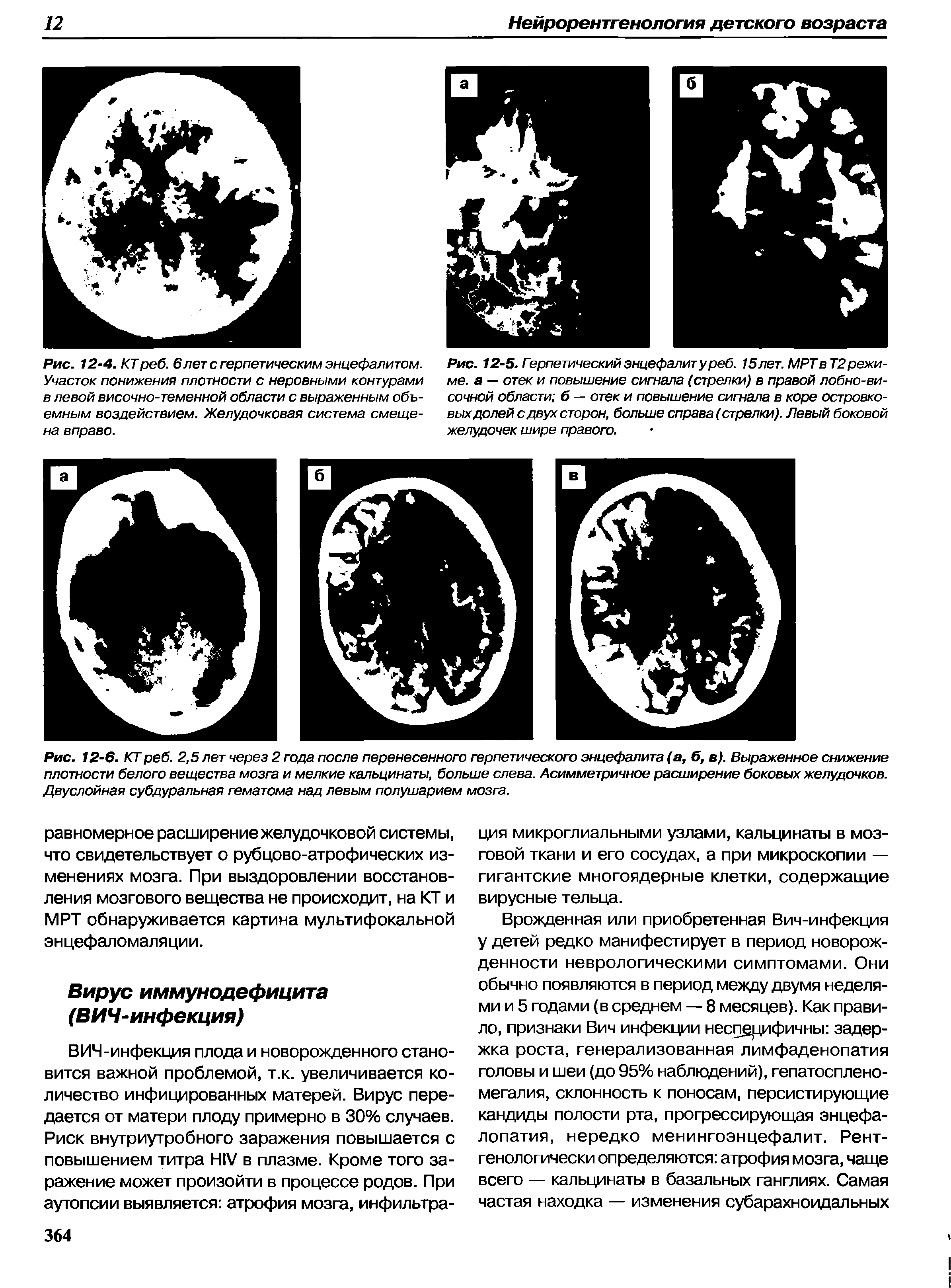 Рис. 12-5. Герпетический энцефалит у реб. 15 лет. МРТ в Т2 режиме. а — отек и повышение сигнала (стрелки) в правой лобно-височной области б — отек и повышение сигнала в коре островковых долей с двух сторон, больше справа (стрелки). Левый боковой желудочек шире правого.