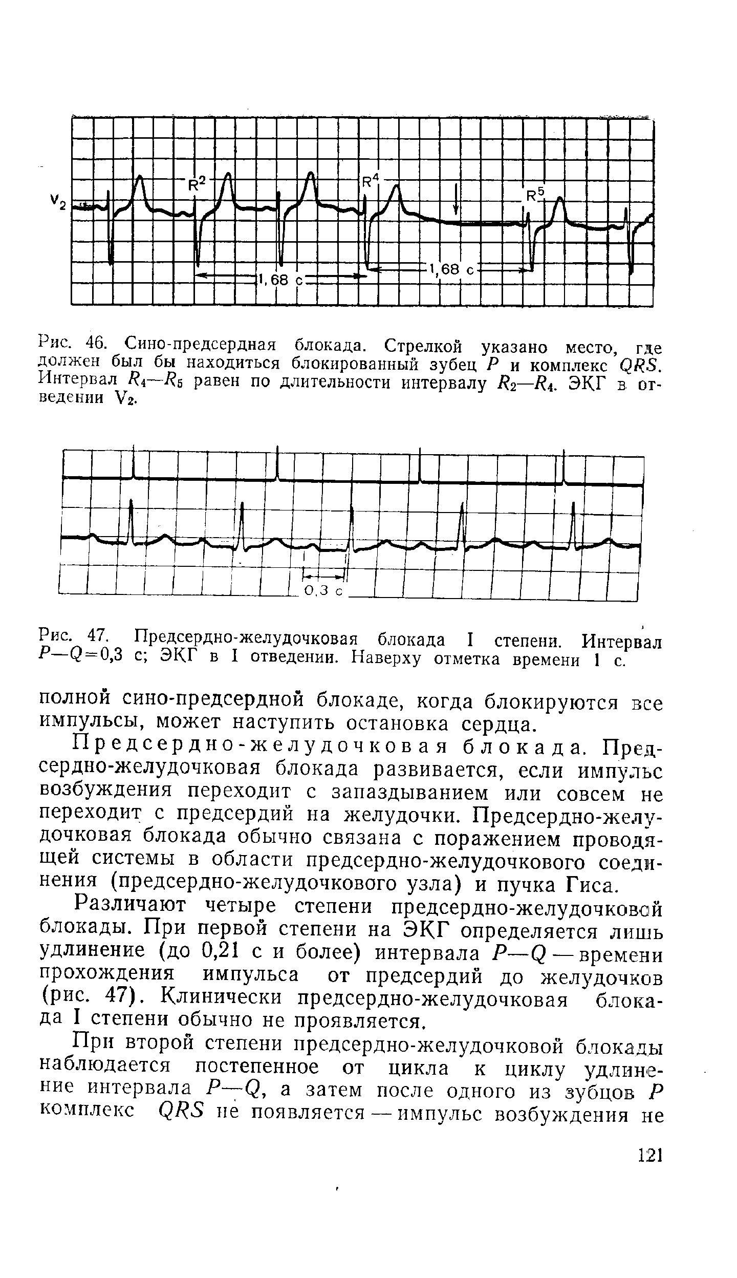 Рис. 46. Сино-предсердная блокада. Стрелкой указано место, где должен был бы находиться блокированный зубец Р и комплекс <2/ 5. Интервал Рг—равен по длительности интервалу Рг—Рь ЭКГ в отведении Уг-...