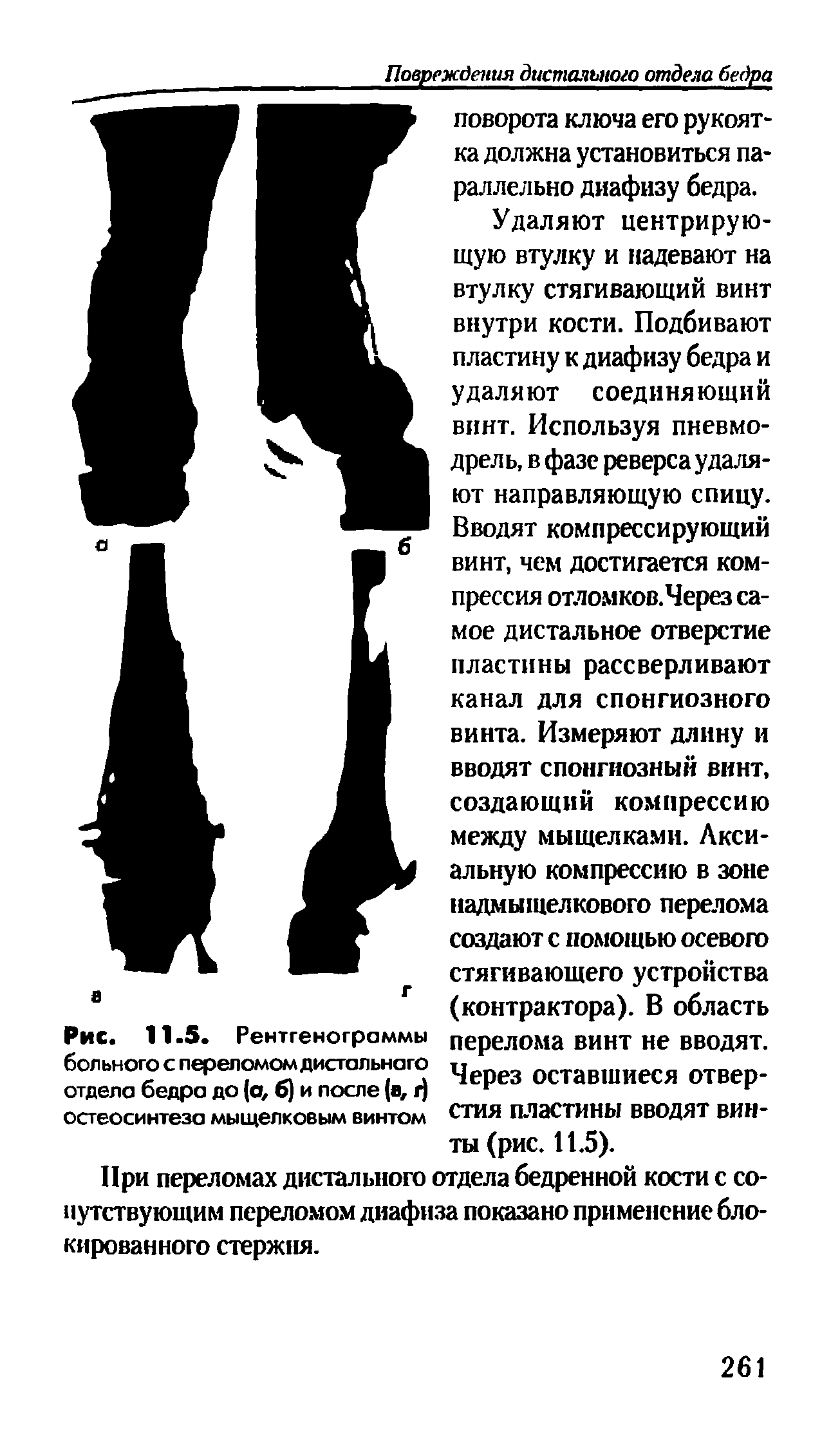 Рис. 11.5. Рентгенограммы больного с переломом дистального отдела бедра до (а, б) и после (а, г) остеосинтеза мыщелковым винтом...