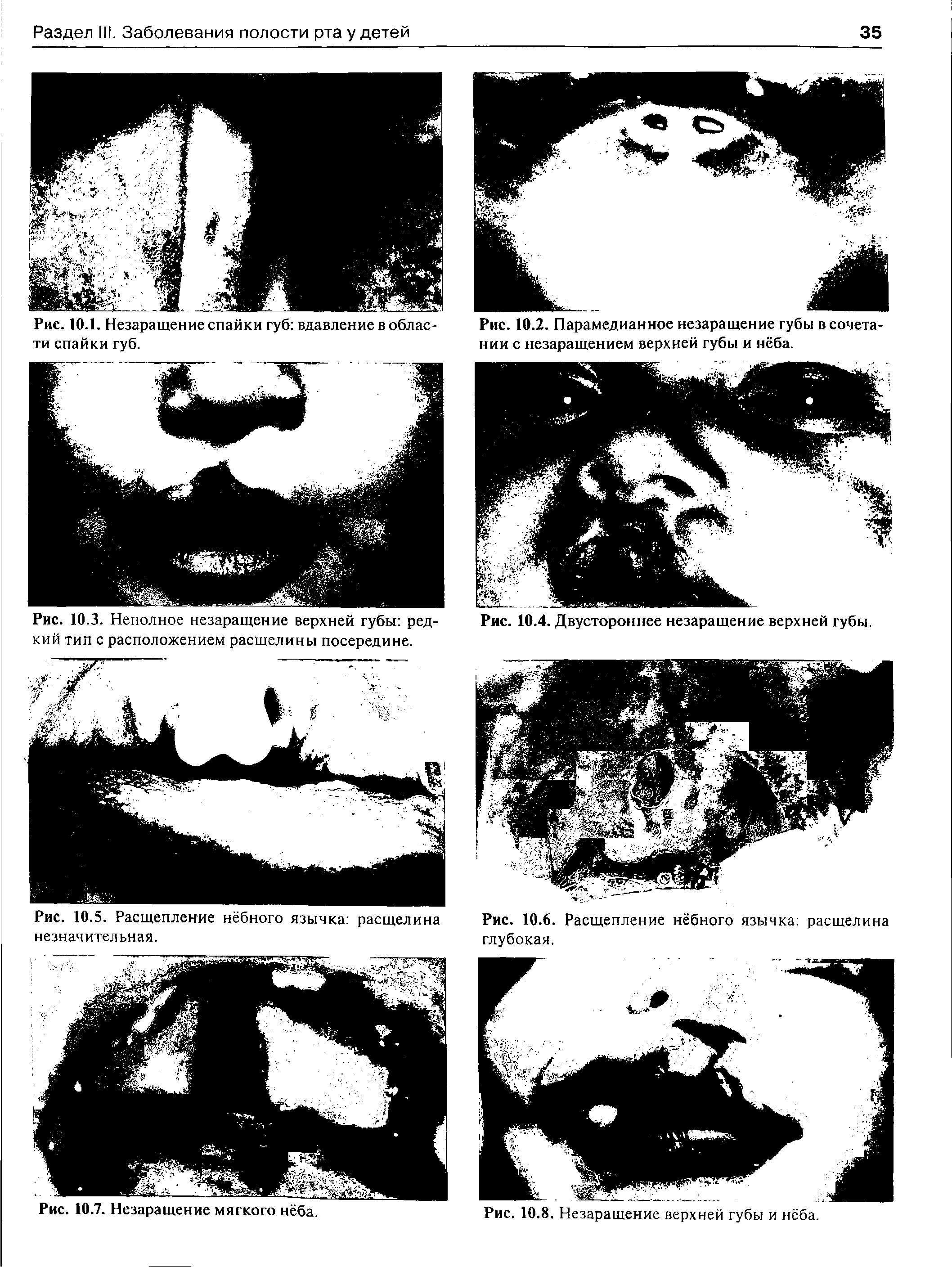 Рис. 10.3. Неполное незаращение верхней губы ред- Рис. 10.4. Двустороннее незаращение верхней губы, кий тип с расположением расщелины посередине.