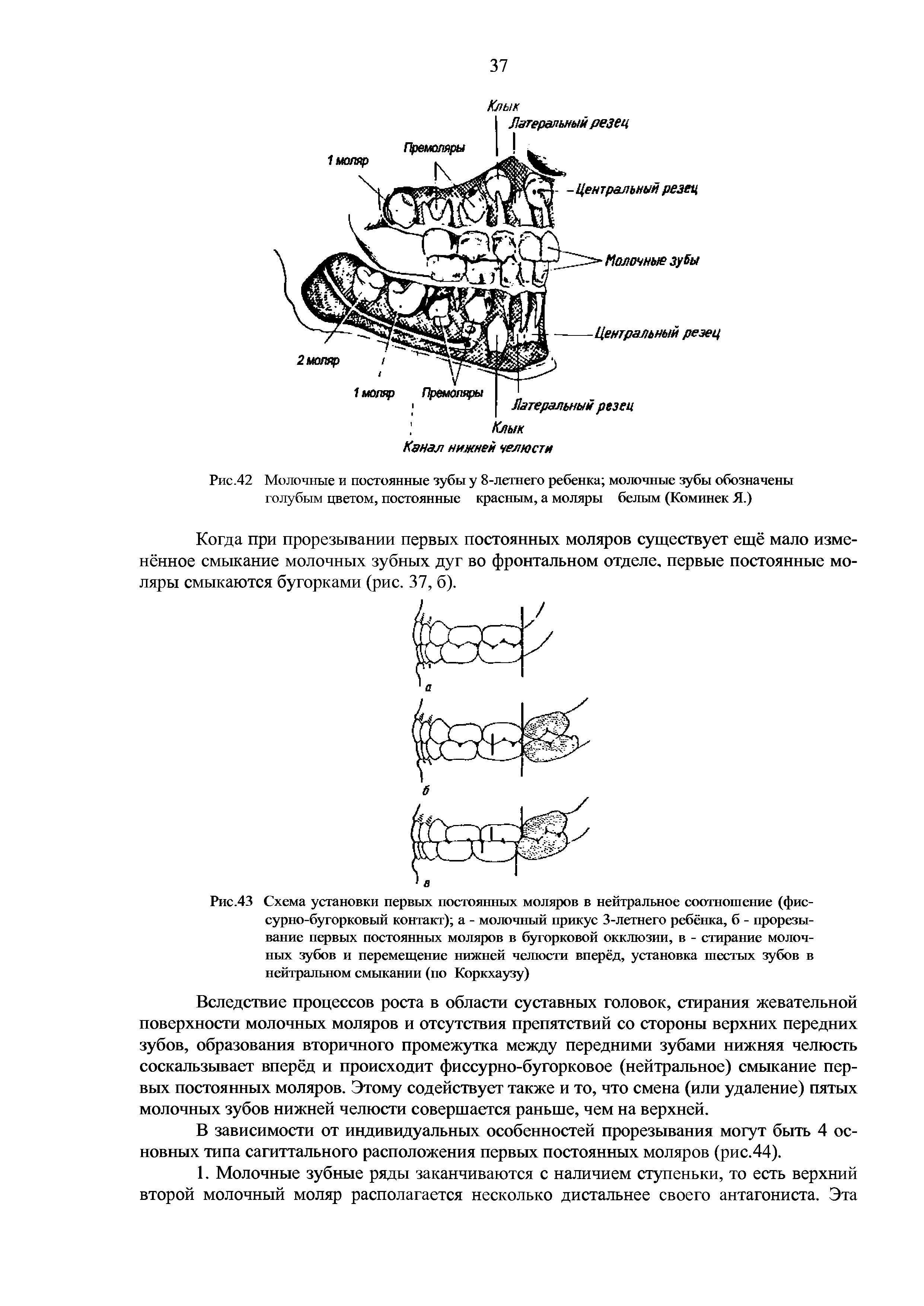 Рис.43 Схема установки первых постоянных моляров в нейтральное соотношение (фиссурно-бугорковый контакт) а - молочный прикус 3-летнего ребёнка, б - прорезывание первых постоянных моляров в бугорковой окклюзии, в - стирание молочных зубов и перемещение нижней челюсти вперёд, установка шестых зубов в нейтральном смыкании (по Коркхаузу)...
