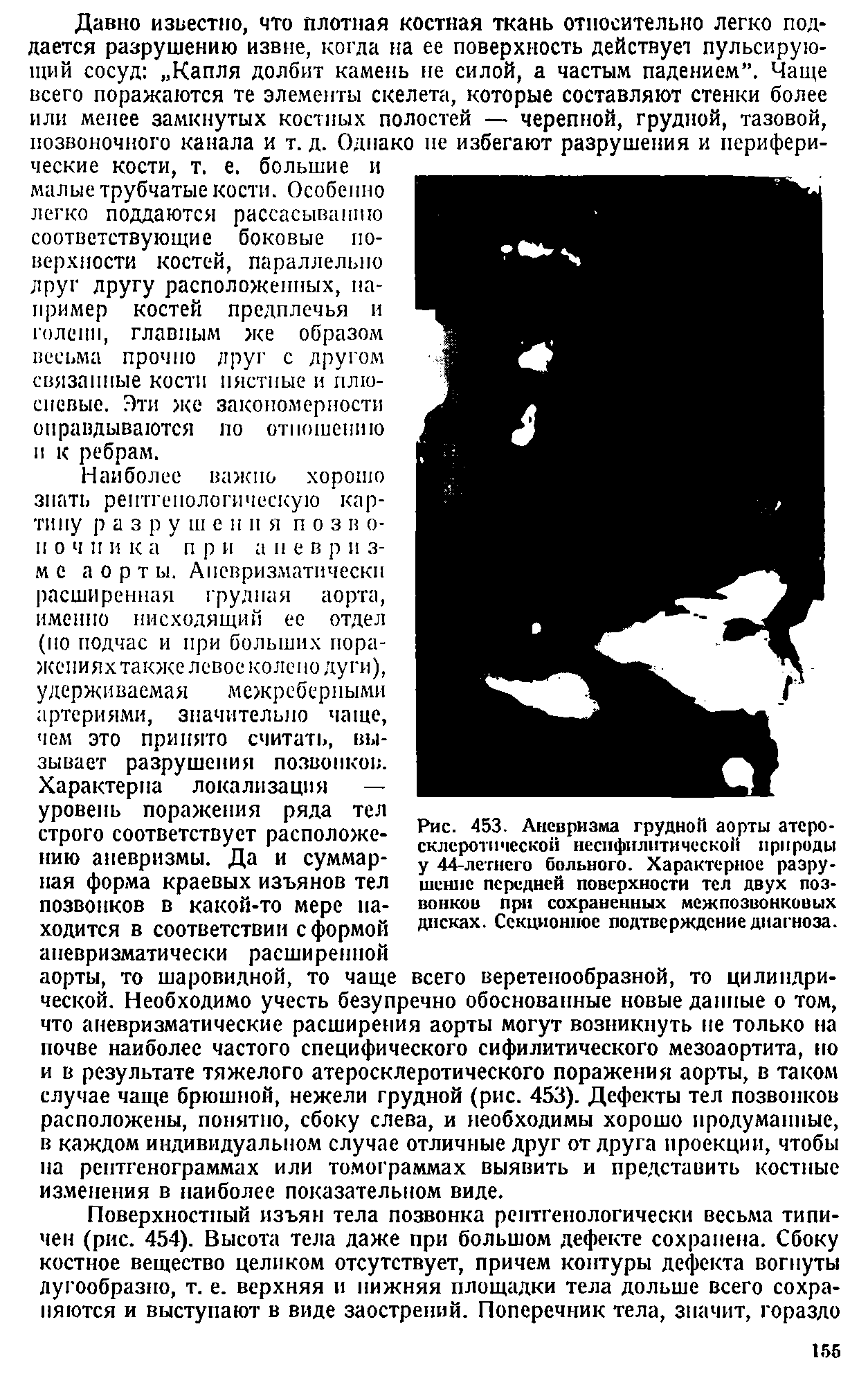 Рис. 453. Аневризма грудной аорты атерс склеротической несифилитической природ у 44-летнего больного. Характерное разр шение передней поверхности тел двух по вонков при сохраненных межпозвонковь дисках. Секционное подтверждение диагноз...