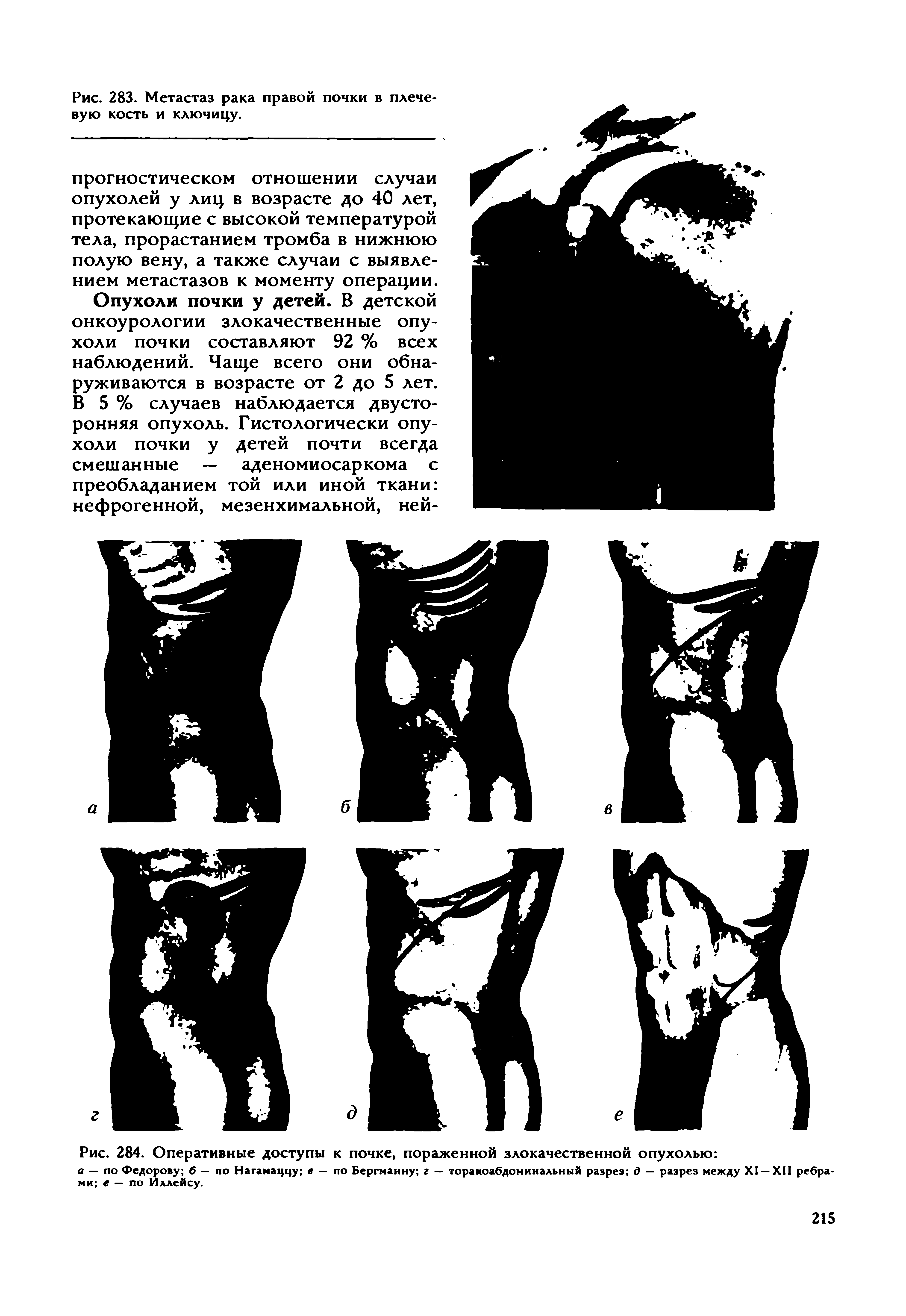 Рис. 284. Оперативные доступы к почке, пораженной злокачественной опухолью ...