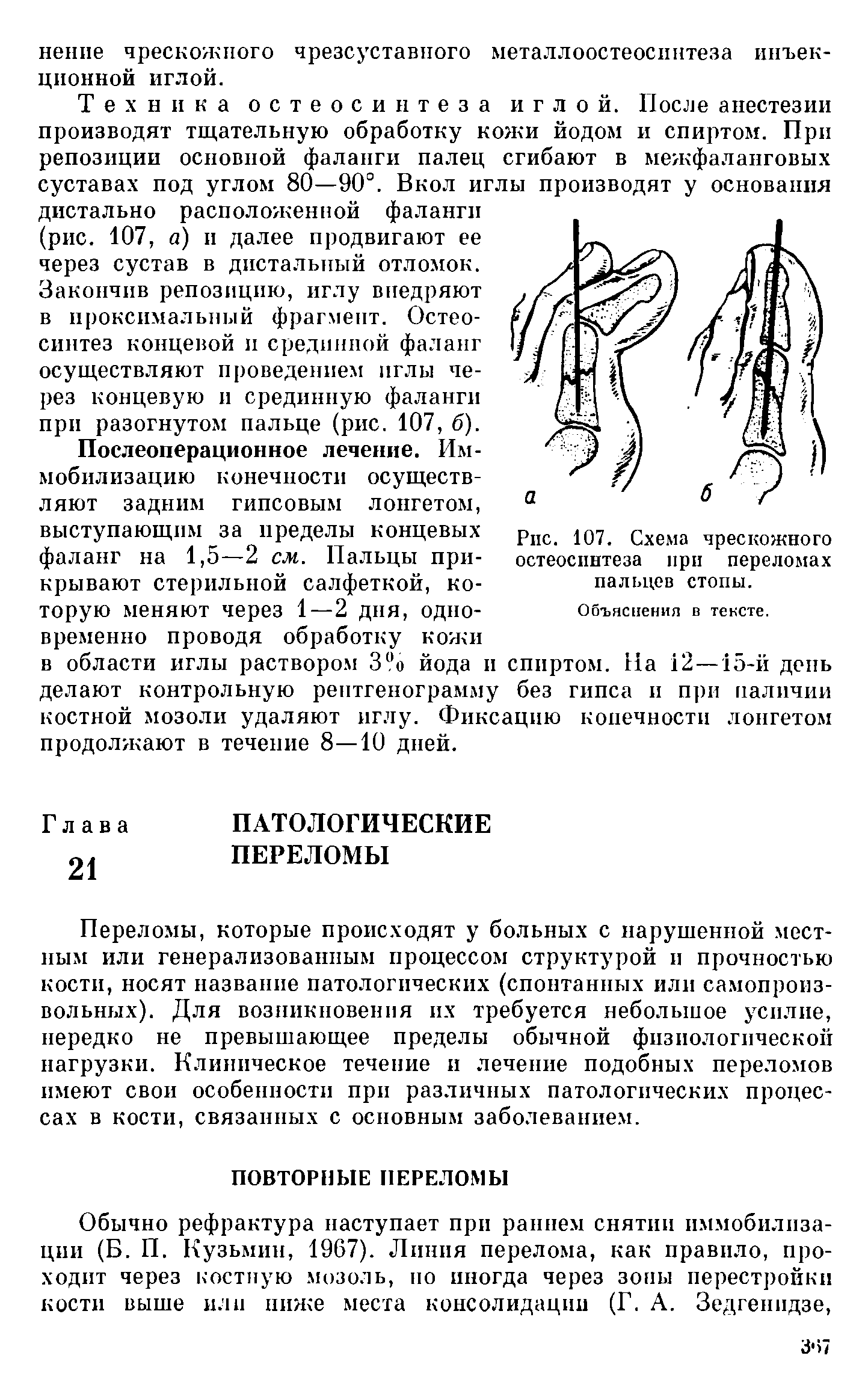 Рис. 107. Схема чрескожного остеосинтеза при переломах пальцев стопы.