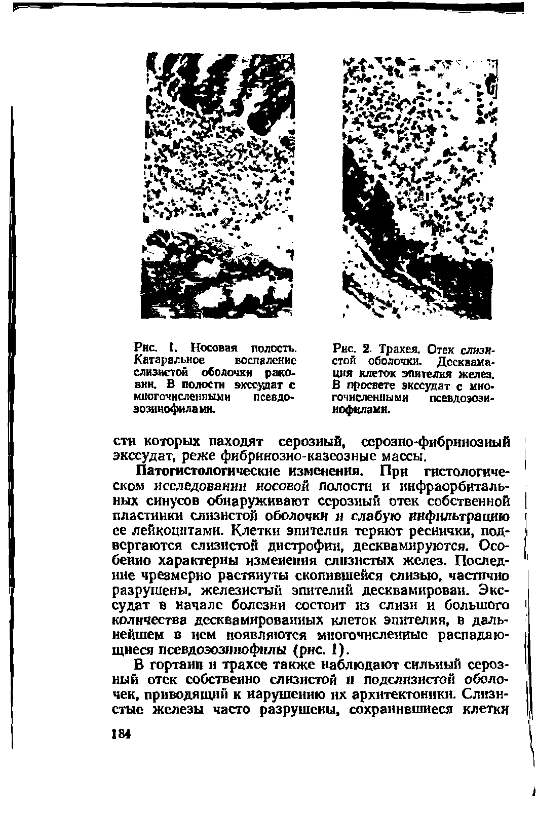 Рис. 2. Трахея. Отек слизистой оболочки. Десквама-ция клеток эпителия желез. В просвете экссудат с мяо гочислениымя псевдоэози-нофнлами.