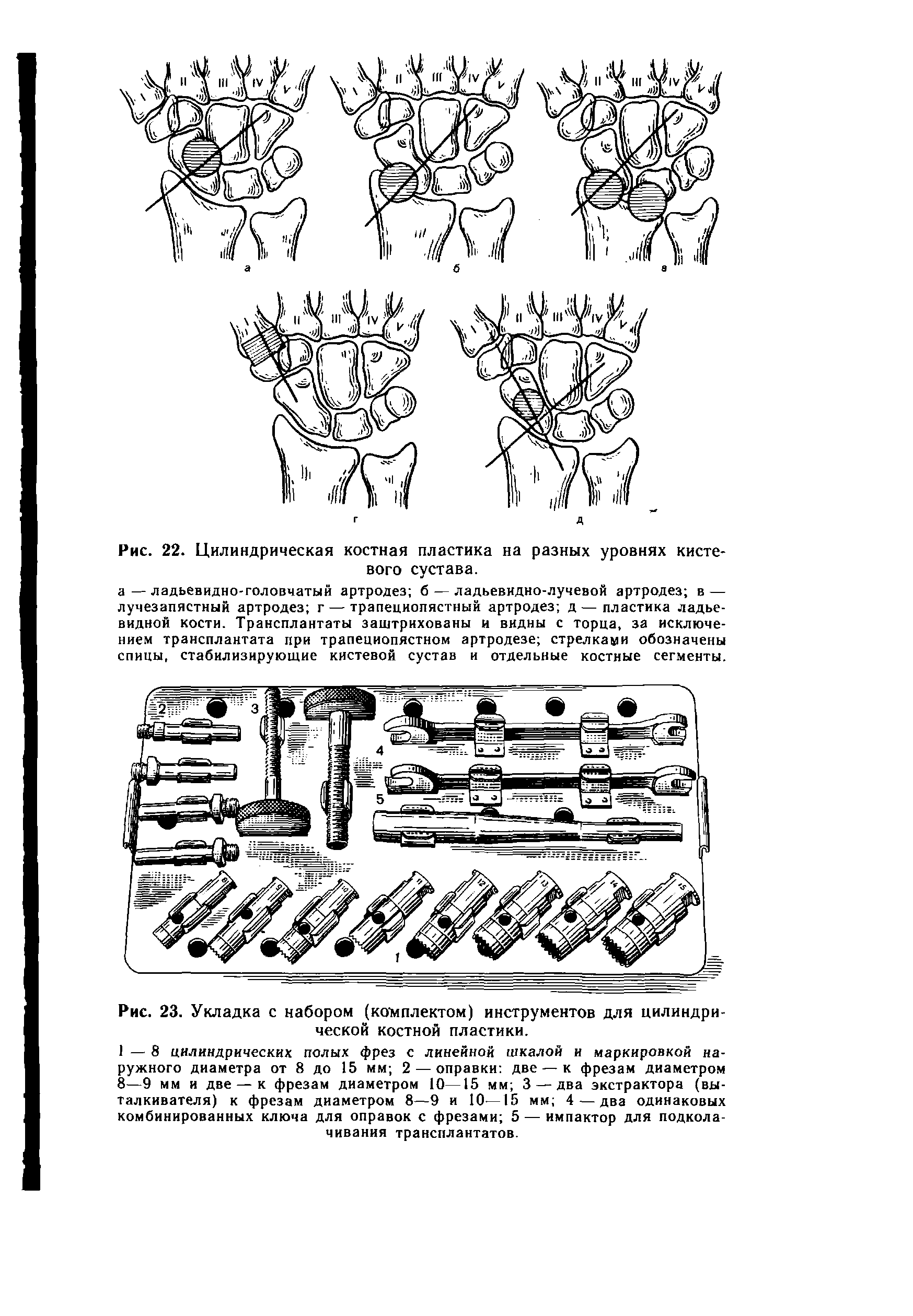 Рис. 23. Укладка с набором (комплектом) инструментов для цилиндрической костной пластики.