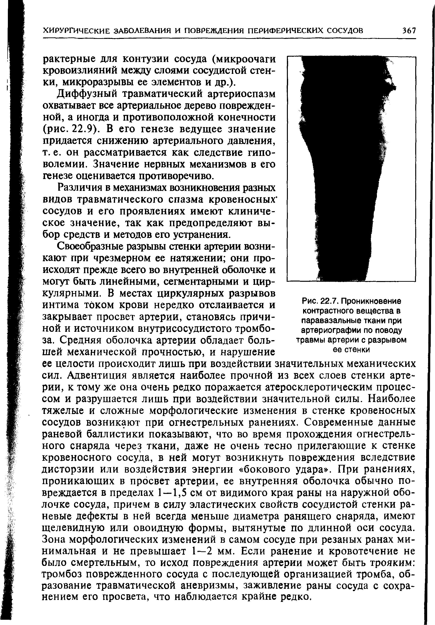 Рис. 22.7. Проникновение контрастного вещества в паравазальные ткани при артериографии по поводу травмы артерии с разрывом ее стенки...