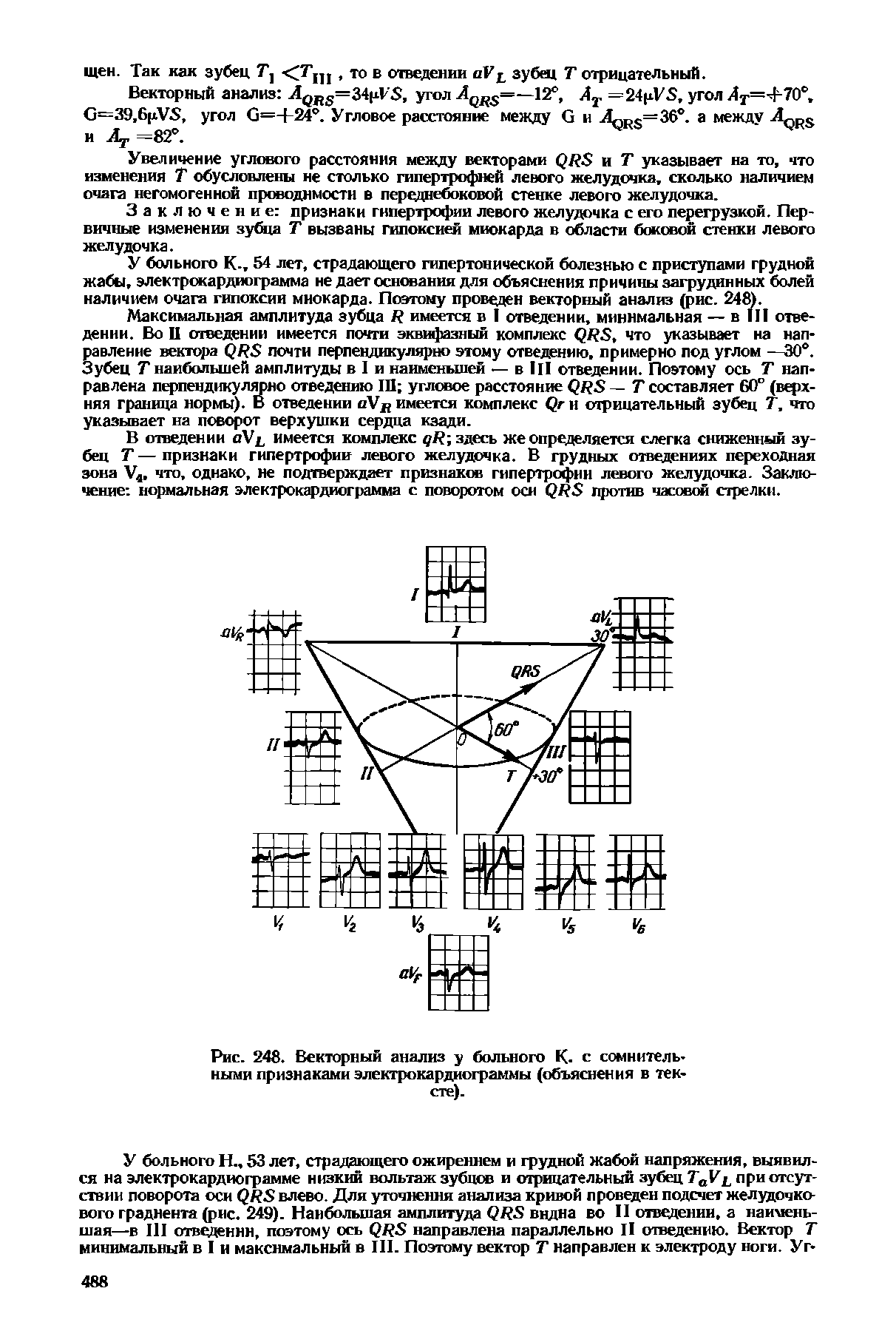 Рис. 248. Векторный анализ у больного К. с сомнительными признаками электрокардиограммы (объяснения в тексте).