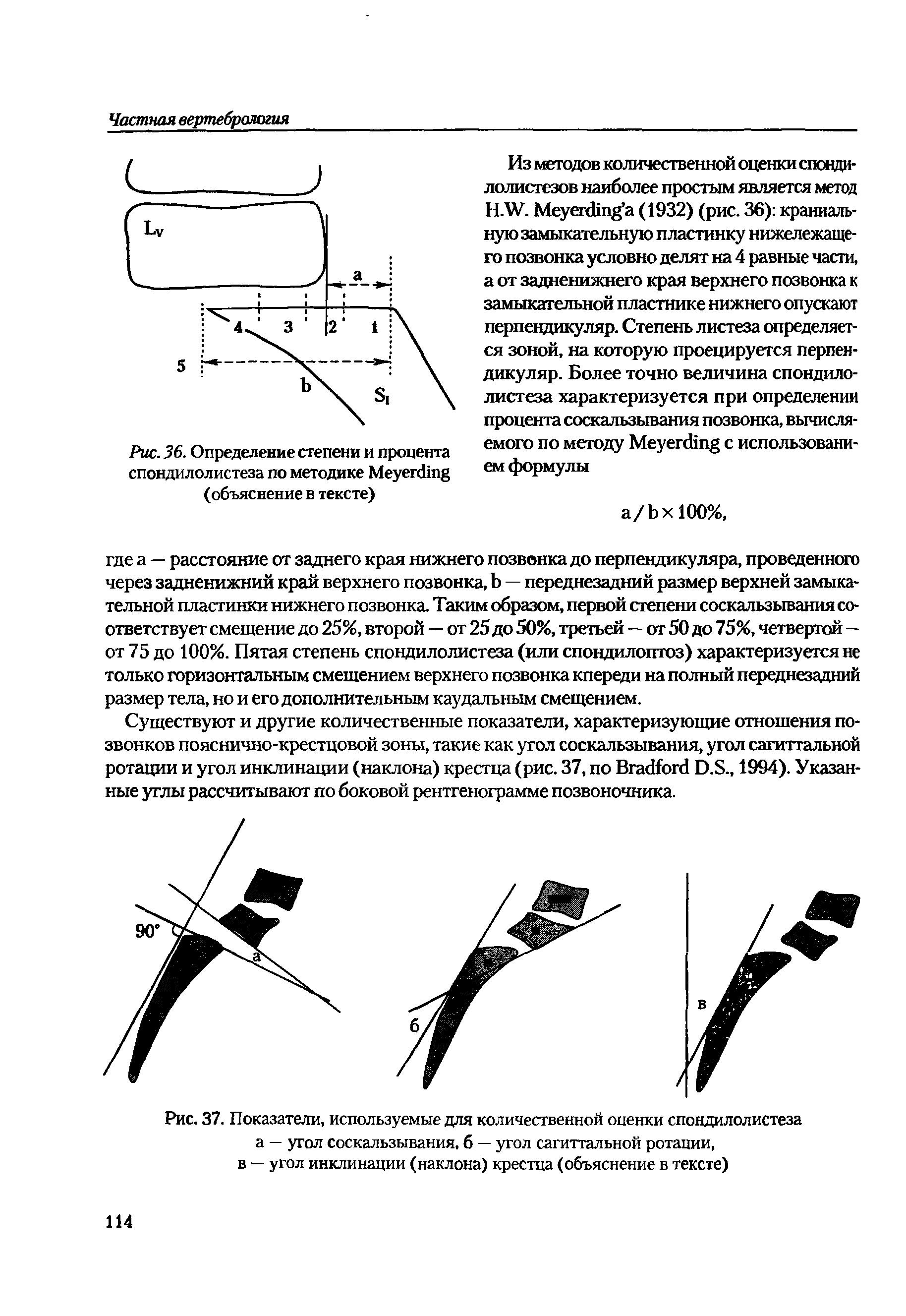 Рис. 37. Показатели, используемые для количественной оценки спондилолистеза а — угол соскальзывания, б — угол сагиттальной ротации, в — угол инклинации (наклона) крестца (объяснение в тексте)...