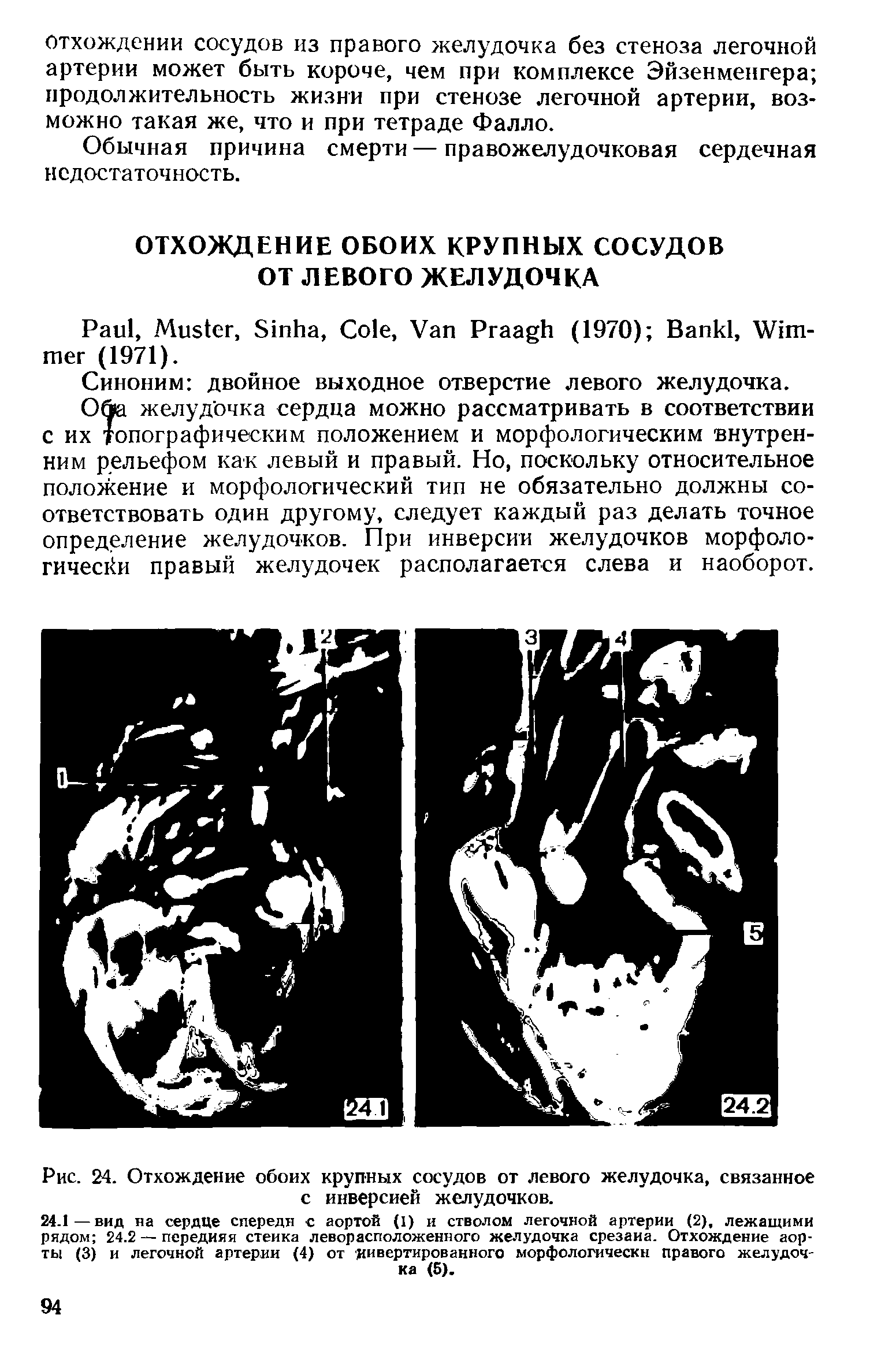 Рис. 24. Отхождение обоих крупных сосудов от левого желудочка, связанное с инверсией желудочков.