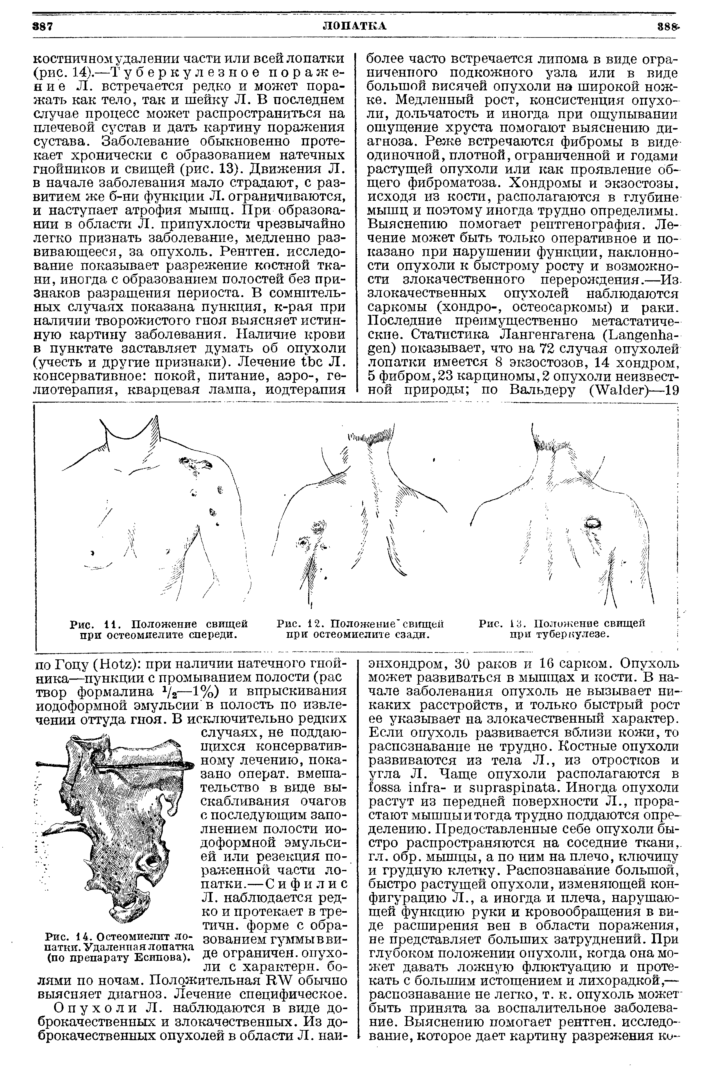 Рис. 14. Остеомиелит лопатки. Удаленпая лопатка (по препарату Есипова).