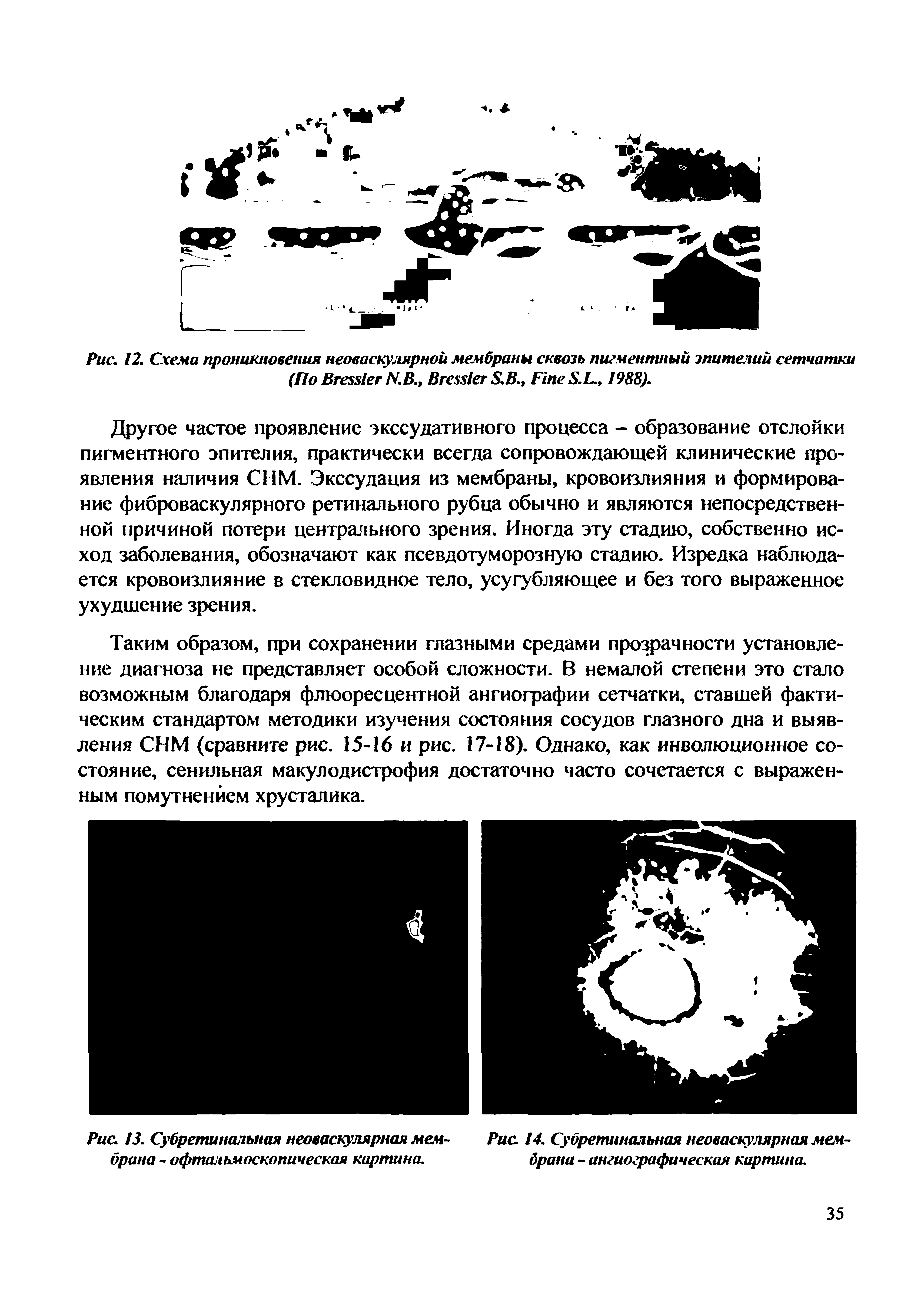 Рис. 13. Субретинальная неоваскулярная мем- Рис. 14. Субретинальная неоваскулярная мембрана - офтальмоскопическая картина. брана - ангиографическая картина.