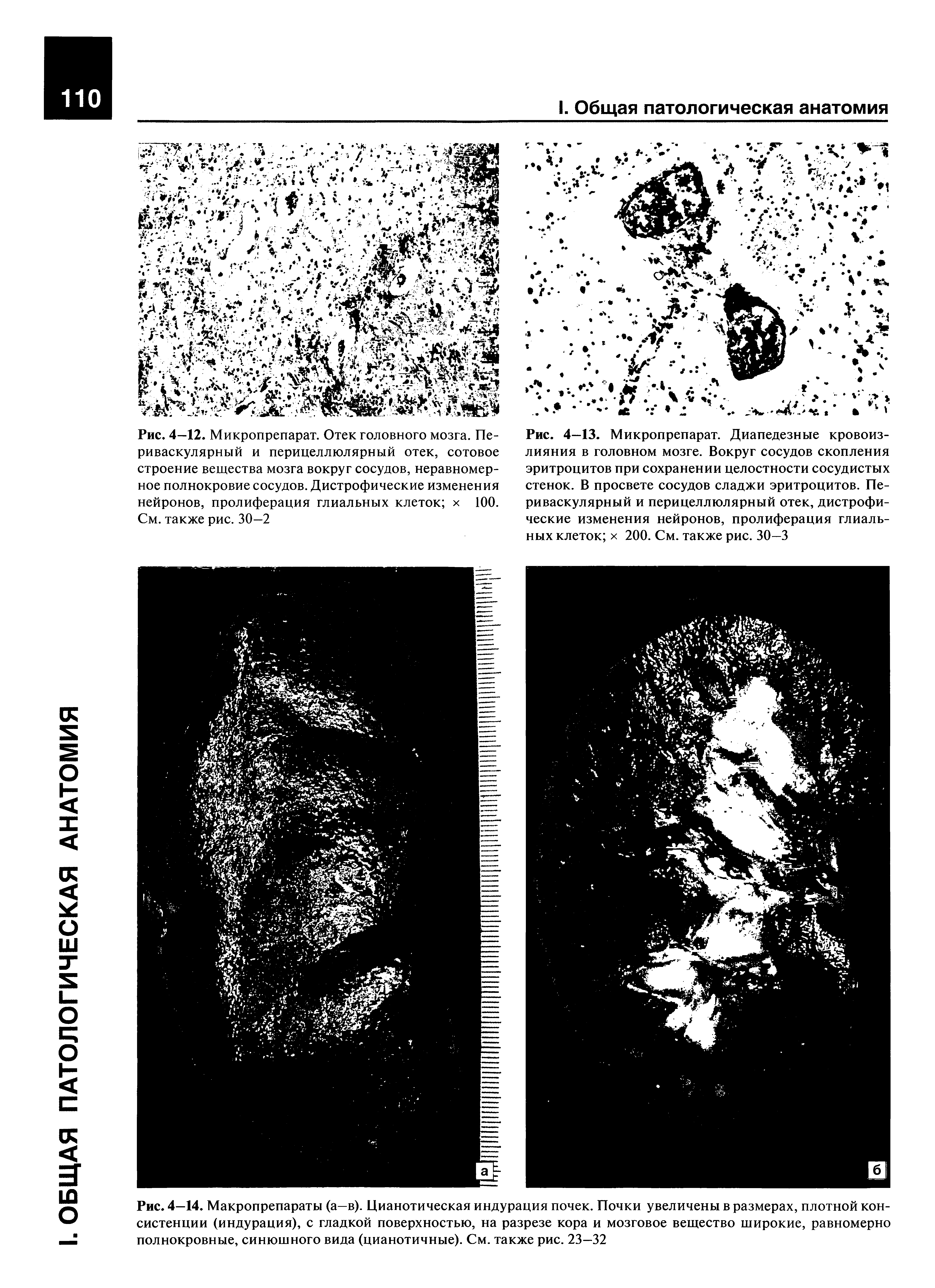 Рис. 4—14. Макропрепараты (а—в). Цианотическая индурация почек. Почки увеличены в размерах, плотной консистенции (индурация), с гладкой поверхностью, на разрезе кора и мозговое вещество широкие, равномерно полнокровные, синюшного вида (цианотичные). См. также рис. 23—32...