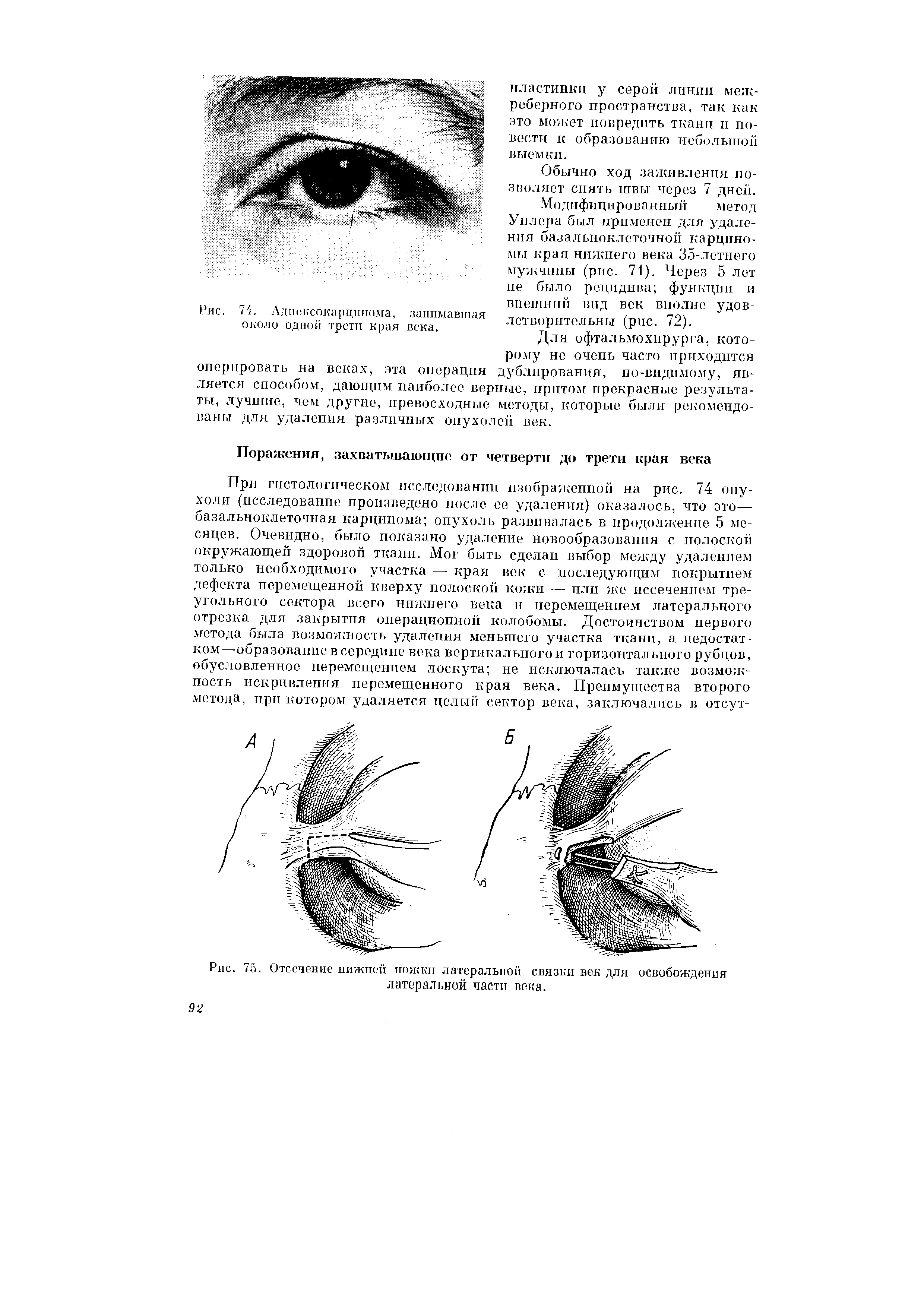 Рис. 75. Отсечение нижней ножки латеральной связки век для освобождения латеральной части века.