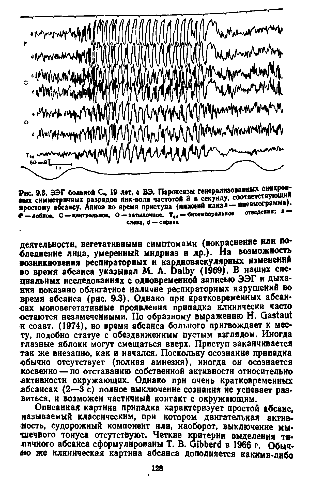 Рис. 9.3. ЭЭГ больной С, 19 лет, с ВЭ. Пароксизм генерализованных сивхрои-аых симметричных разрядов пнк-воли частотой 3 в секунду, соответству иии простому абсансу. Апноэ во время приступа (нижний канал — пневмограмма .